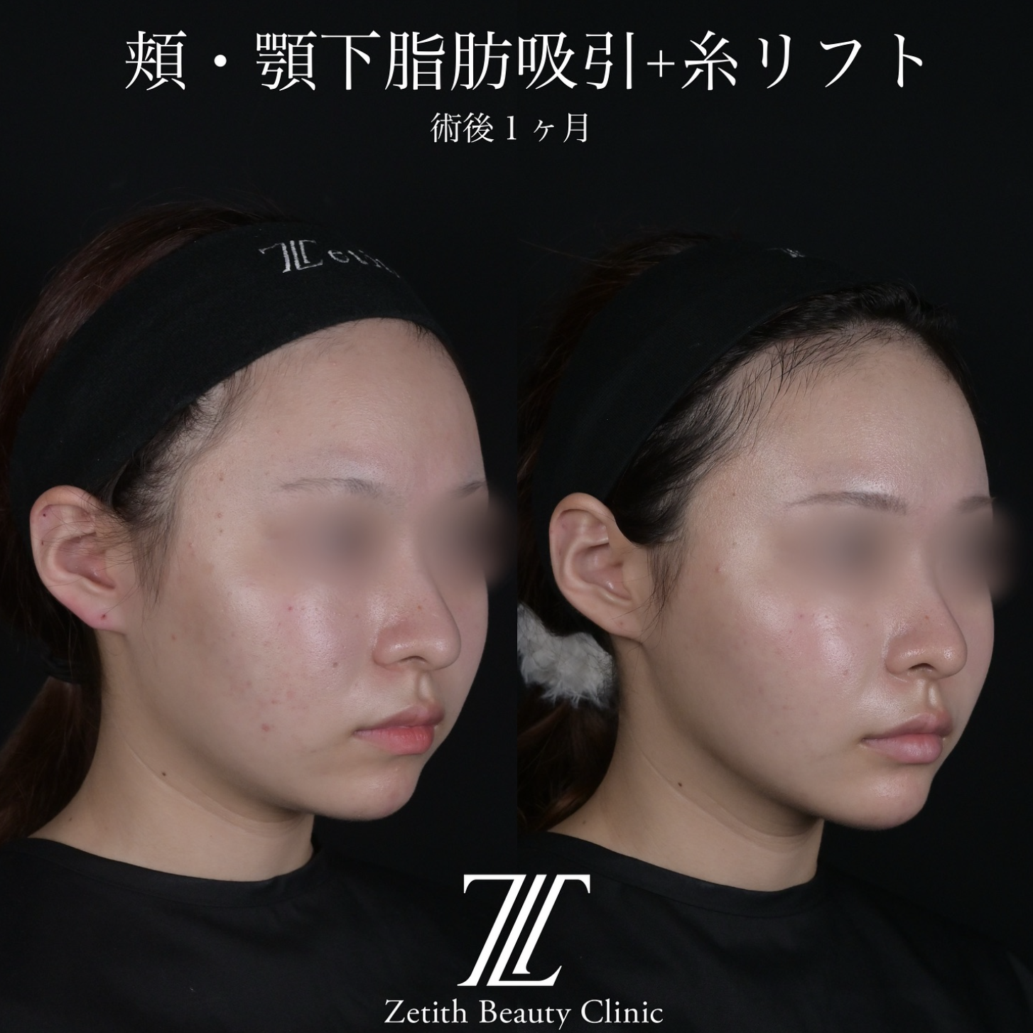 北村医師による脂肪吸引リフトの施術前／施術後1ヶ月 施術後 