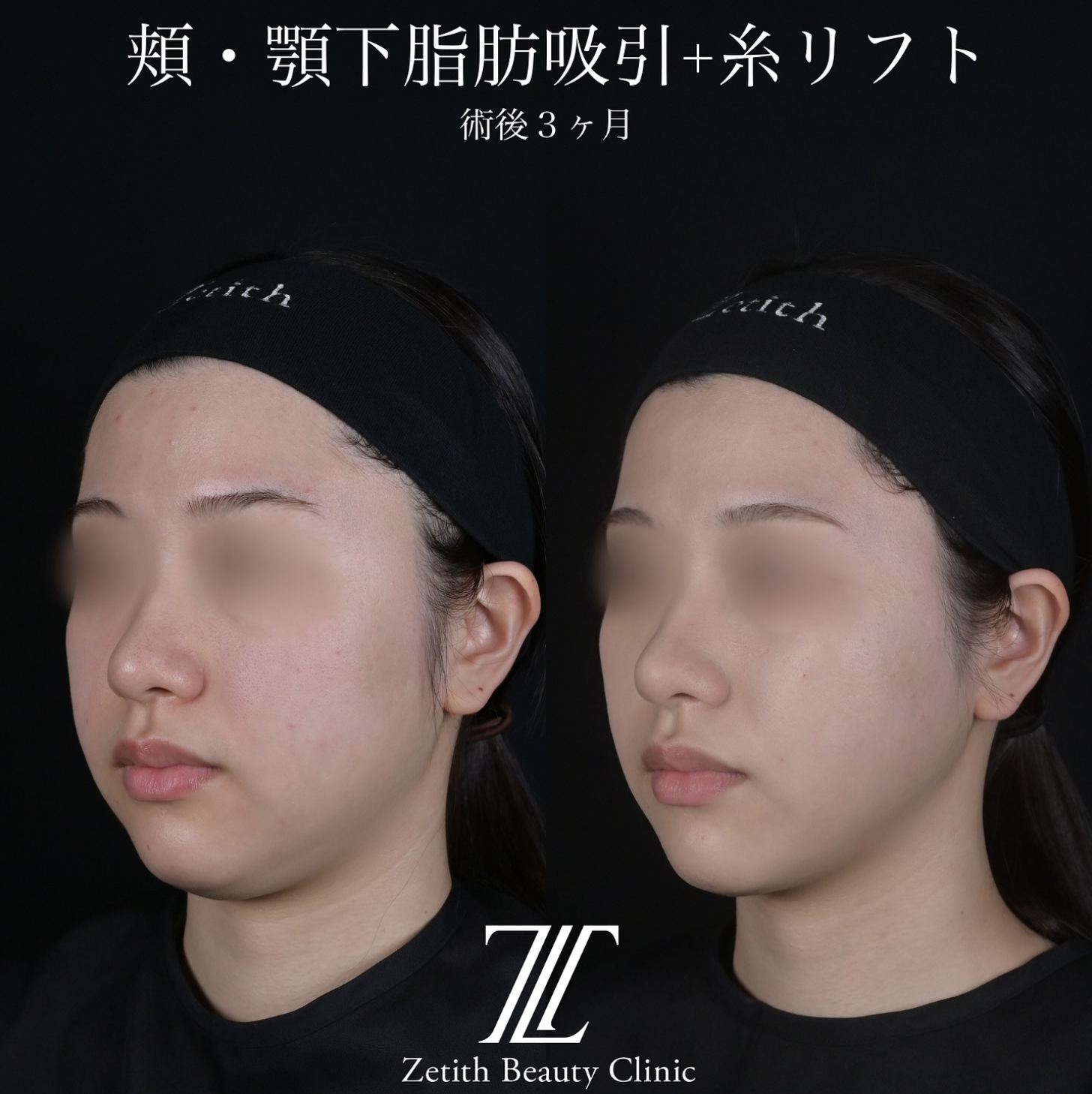 北村医師による脂肪吸引リフトの施術前／施術後3ヶ月