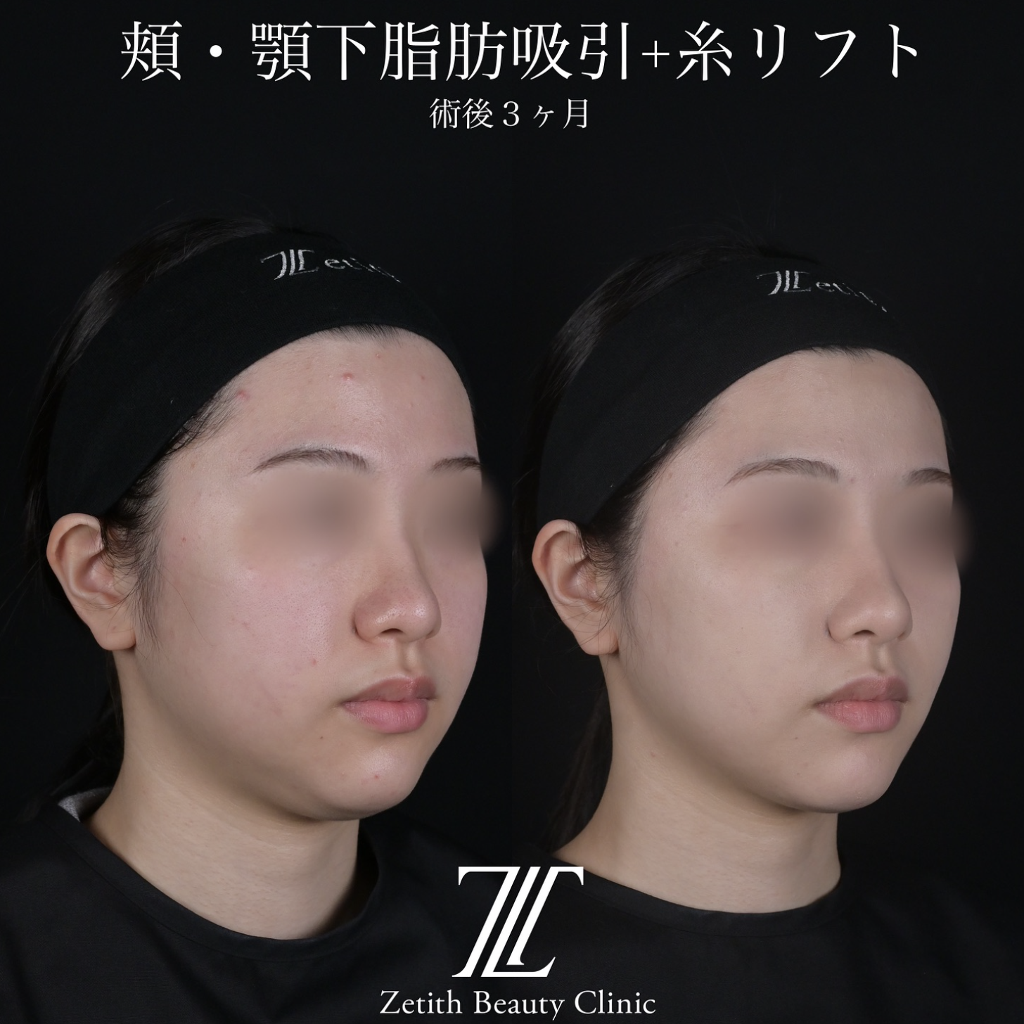 北村医師による脂肪吸引リフトの施術前／施術後3ヶ月 施術後 