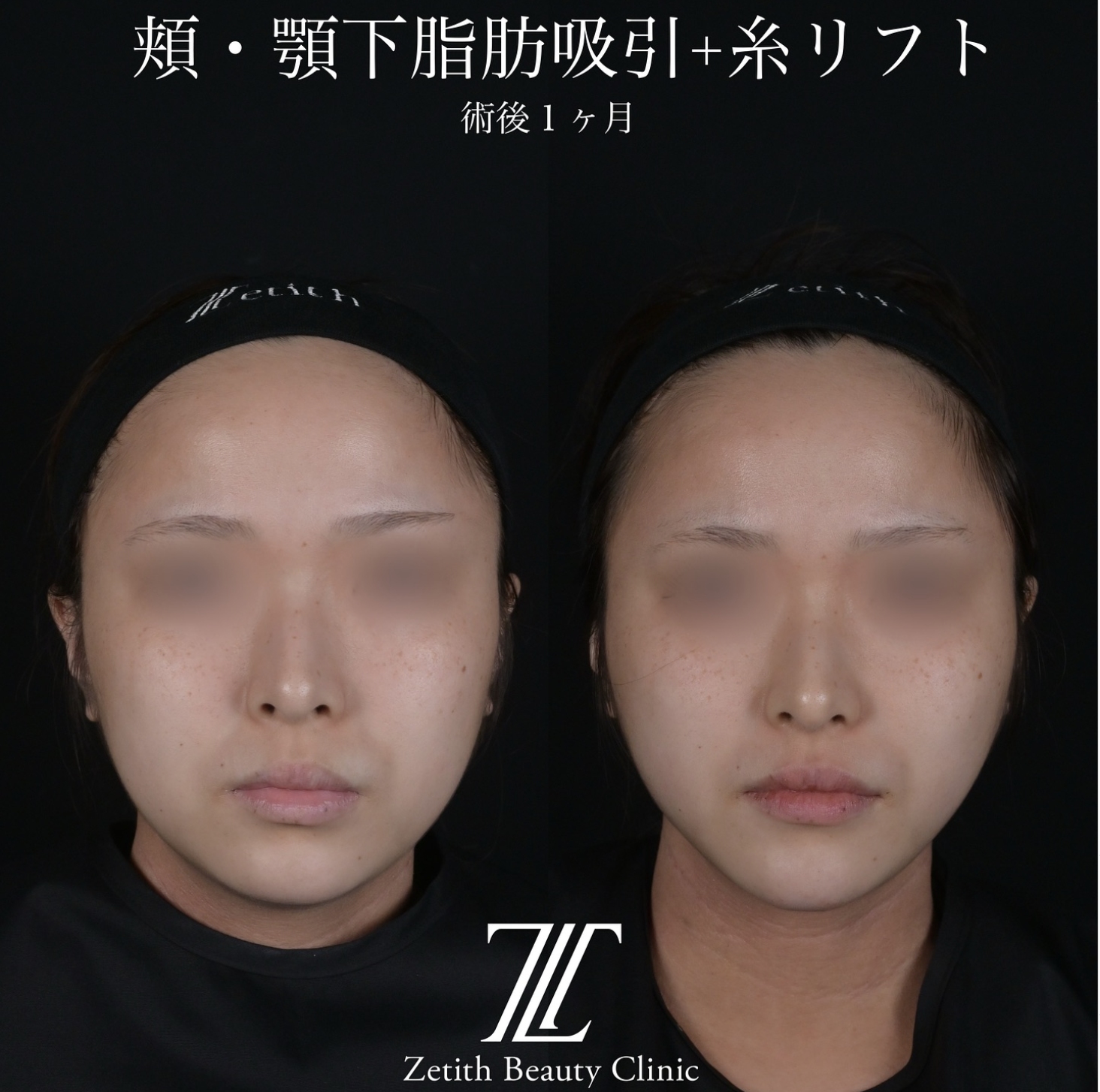 北村医師による脂肪吸引リフトの施術前／施術後1ヶ月