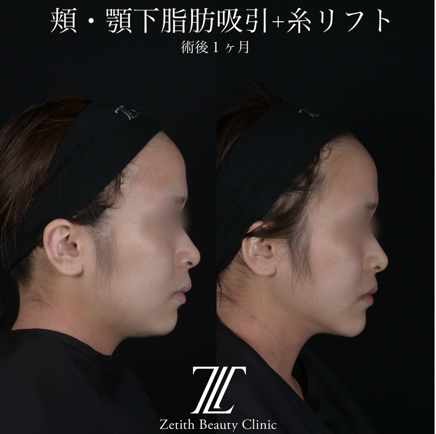北村医師による脂肪吸引リフトの施術前／施術後1ヶ月 After 
