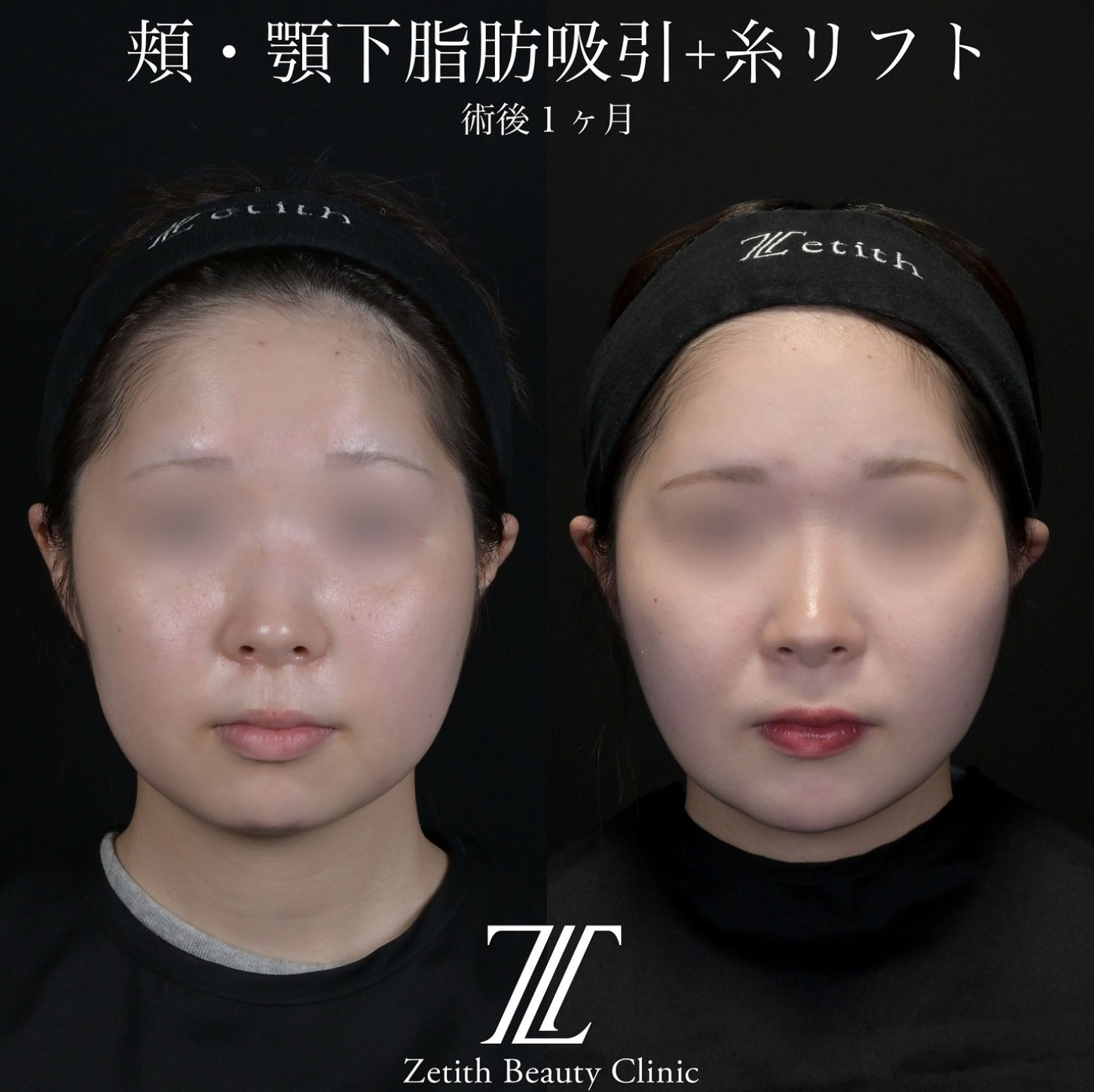 北村医師による脂肪吸引リフトの施術前／施術後1ヶ月