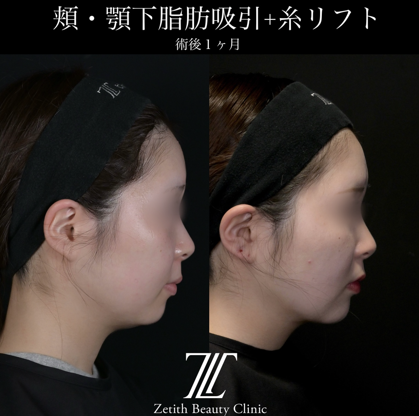 北村医師による脂肪吸引リフトの施術前／施術後1ヶ月 施術後 
