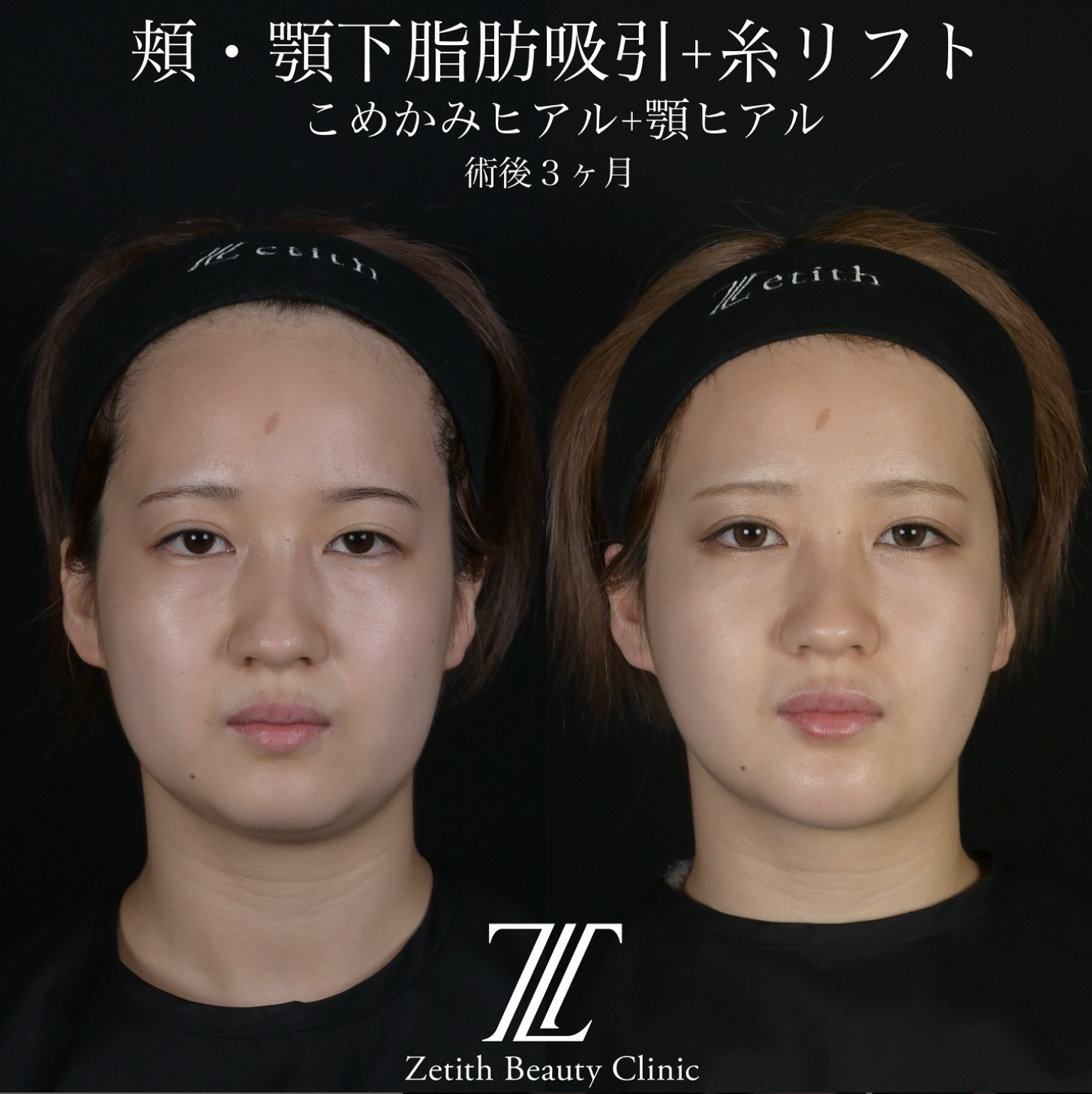 北村医師による脂肪吸引リフトの施術前／施術後3ヶ月
