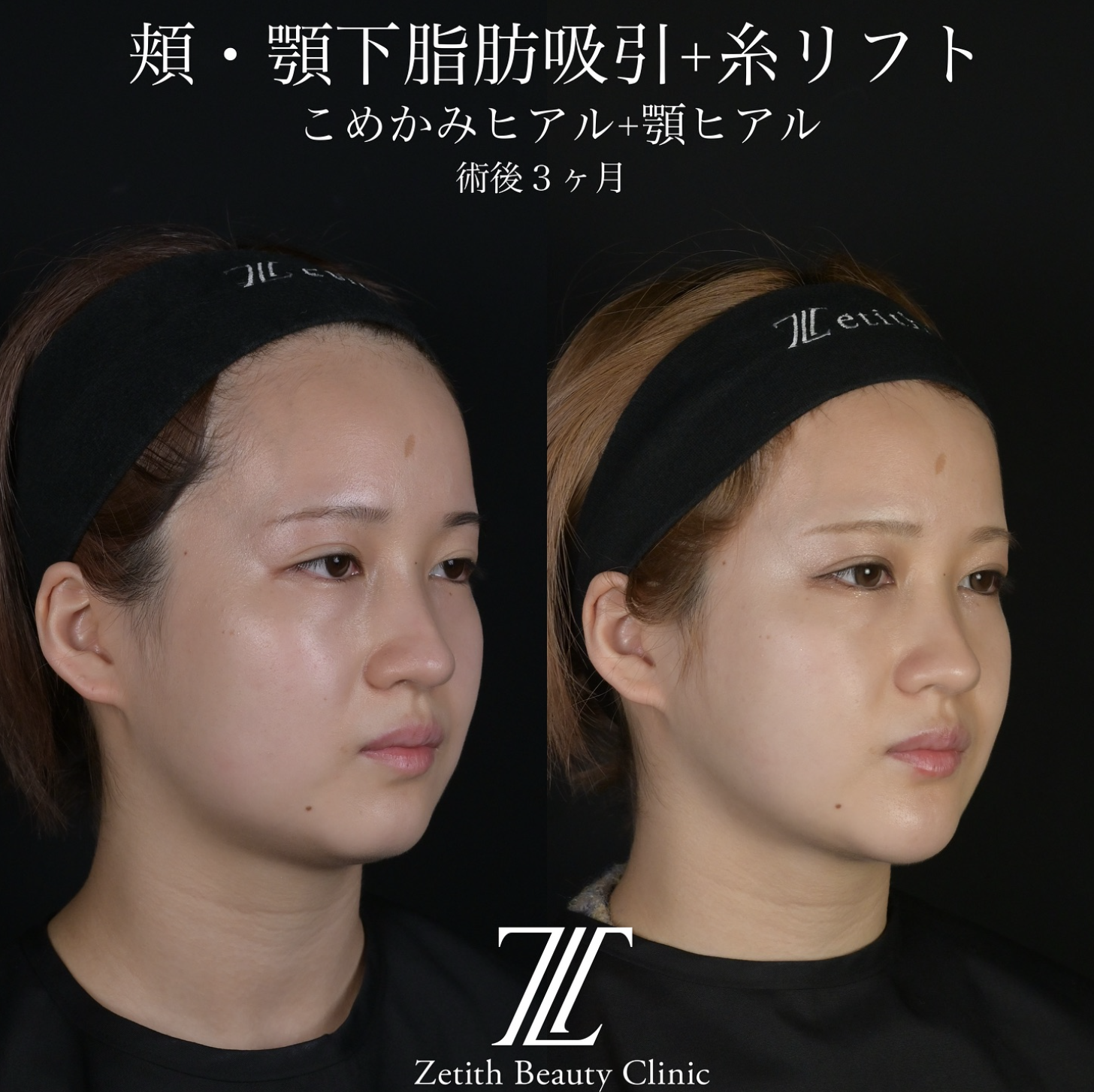 北村医師による脂肪吸引リフトの施術前／施術後3ヶ月 施術後 