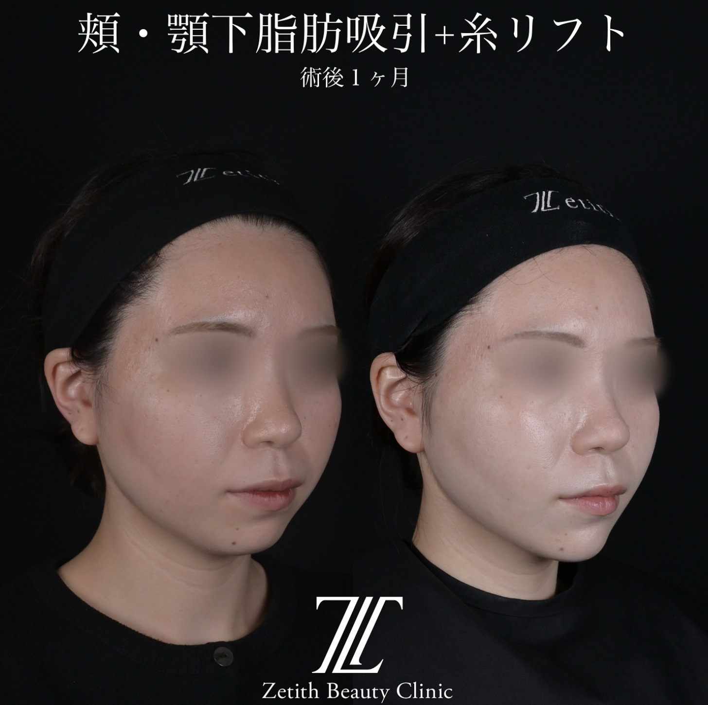 北村医師による脂肪吸引リフトの施術前／施術後1ヶ月