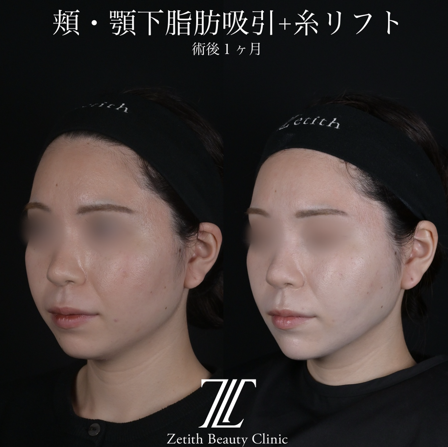 北村医師による脂肪吸引リフトの施術前／施術後1ヶ月 术后 