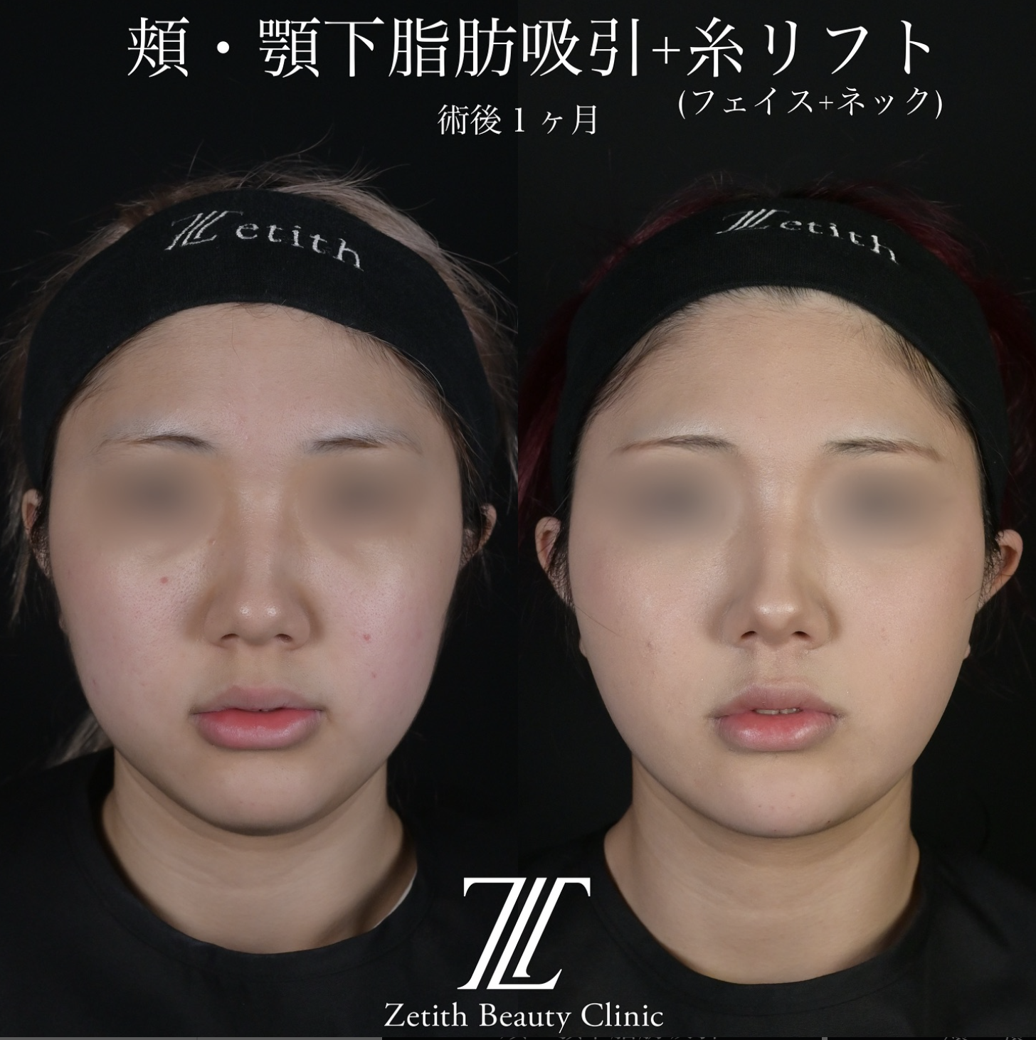 北村医師による脂肪吸引リフトの施術前／施術後1ヶ月