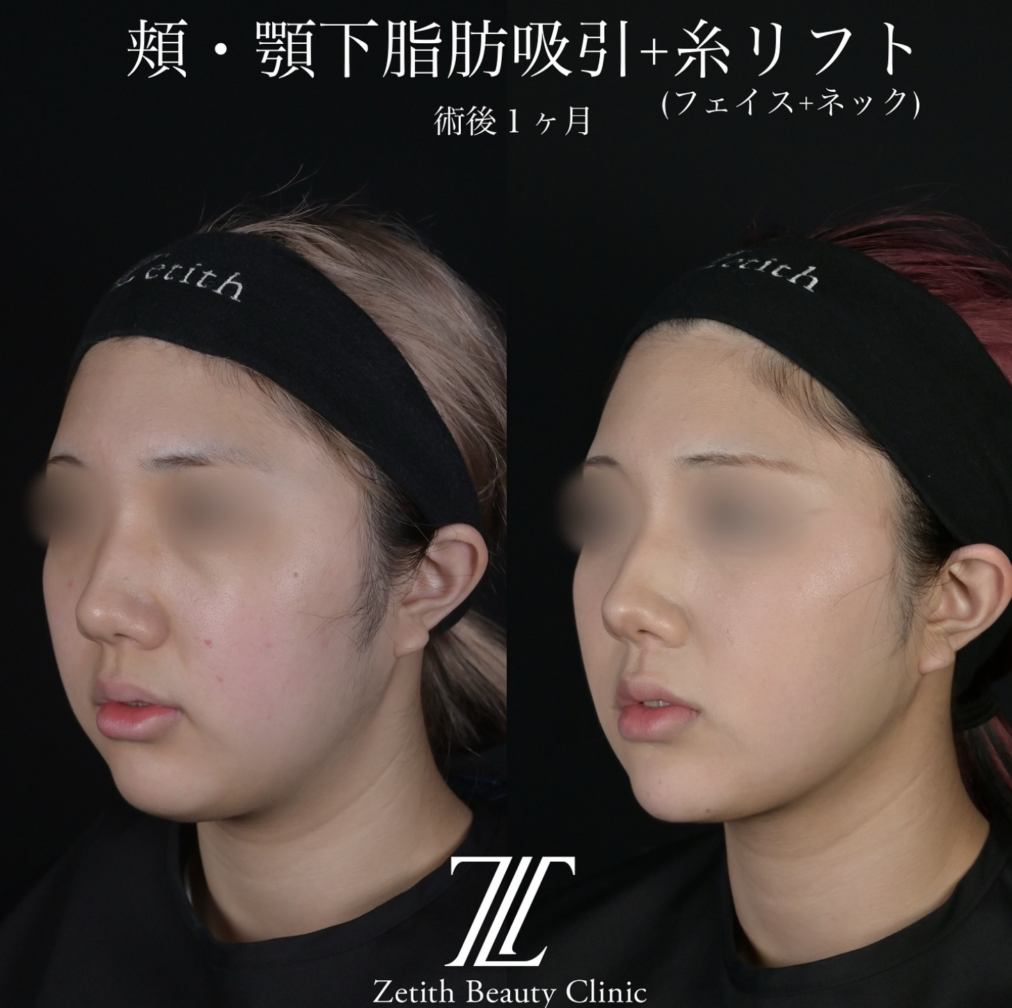 北村医師による脂肪吸引リフトの施術前／施術後1ヶ月 หลัง 