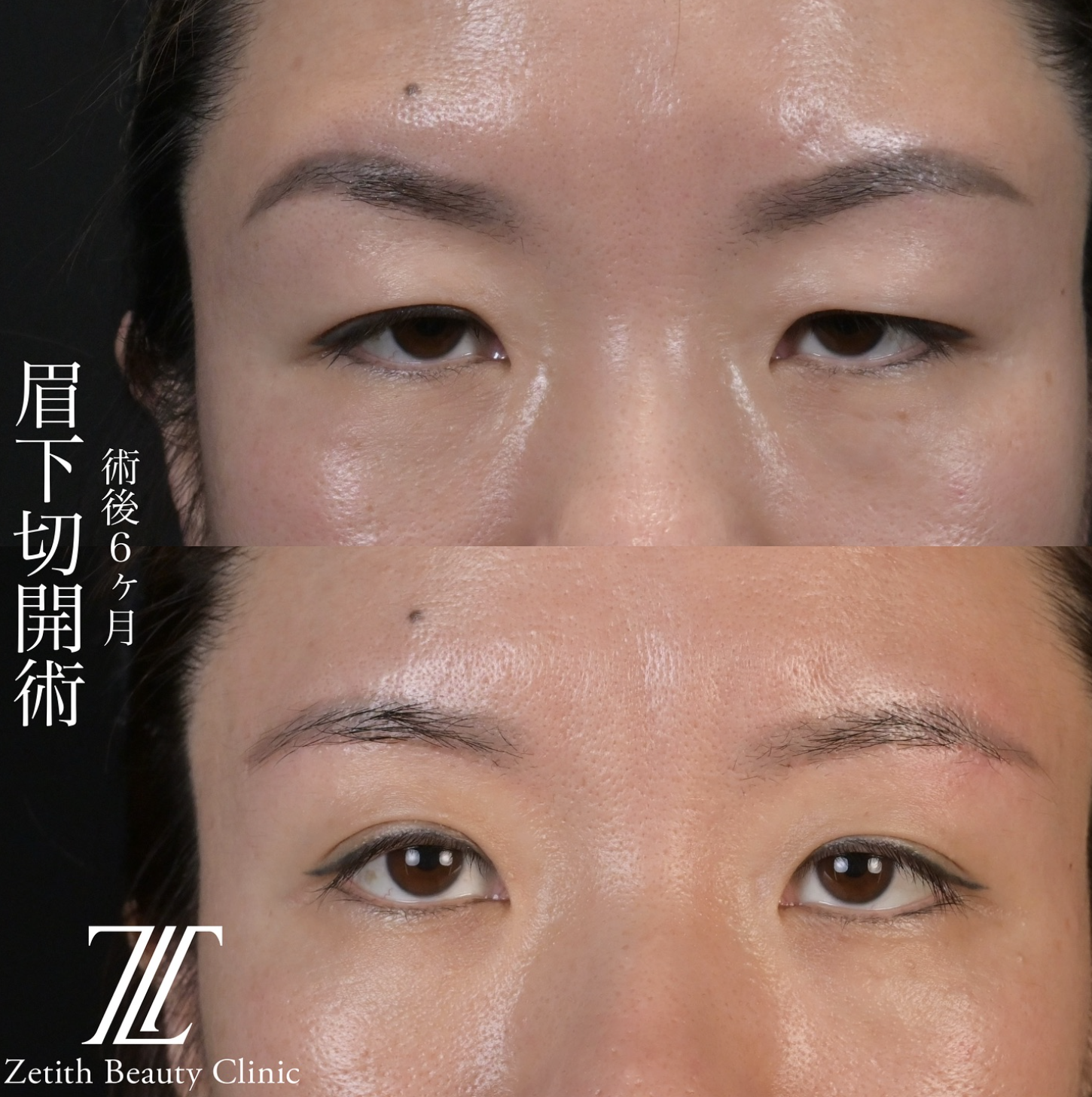 北村医師による眉下切開の施術前／施術後6ヶ月