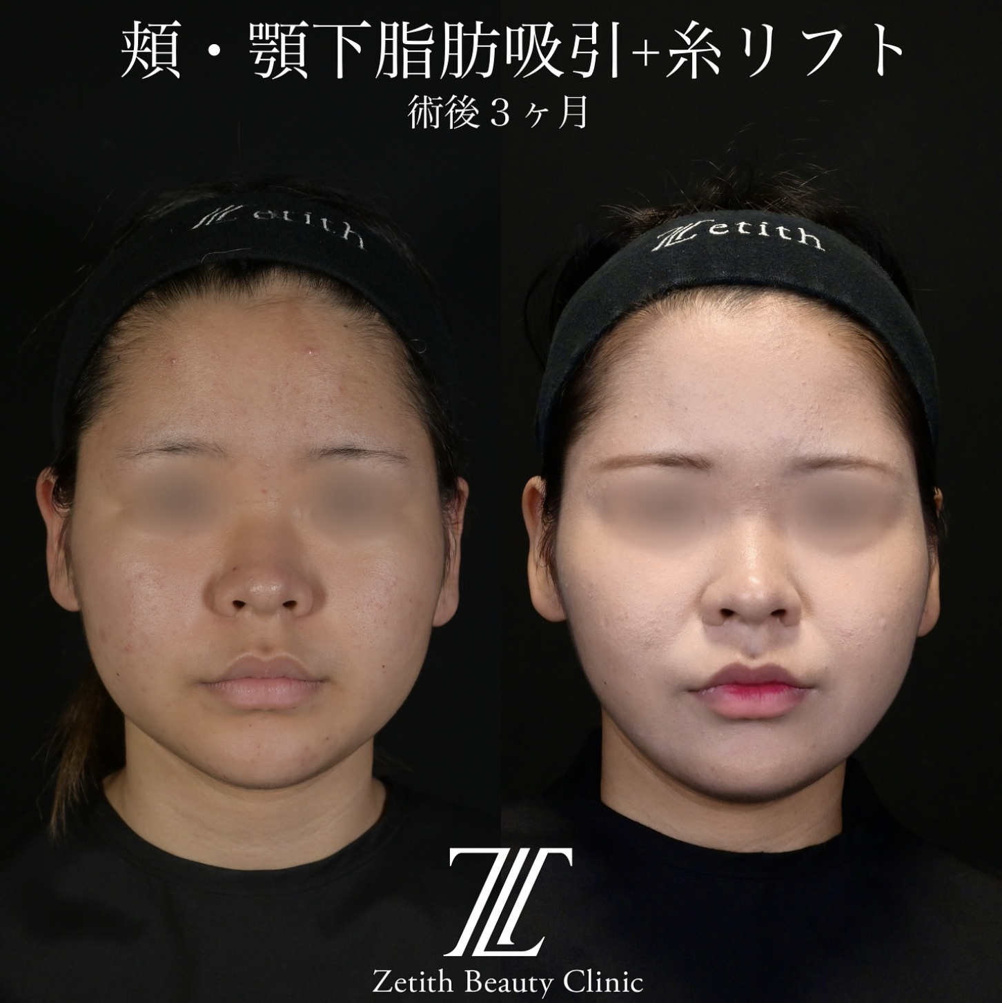 北村医師による脂肪吸引リフトの施術前／施術後3ヶ月