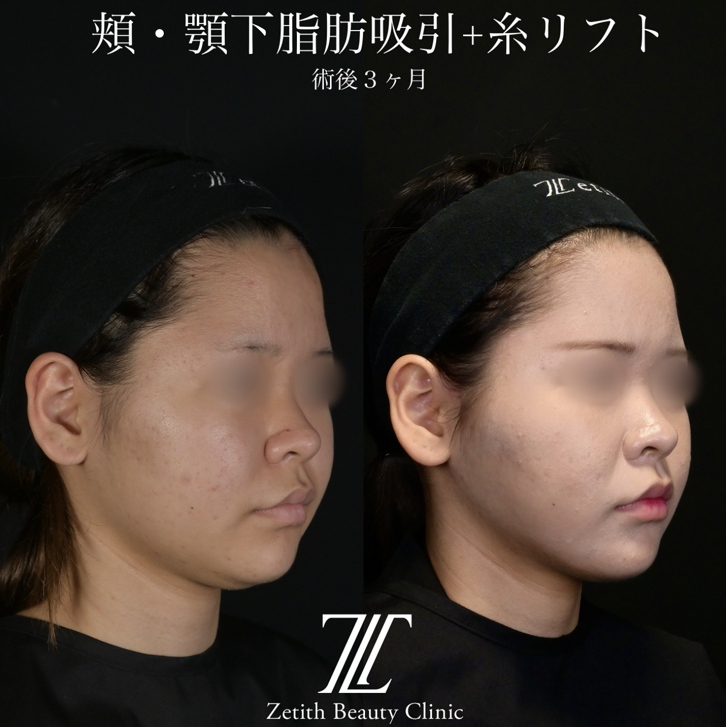 北村医師による脂肪吸引リフトの施術前／施術後3ヶ月 Sonra 
