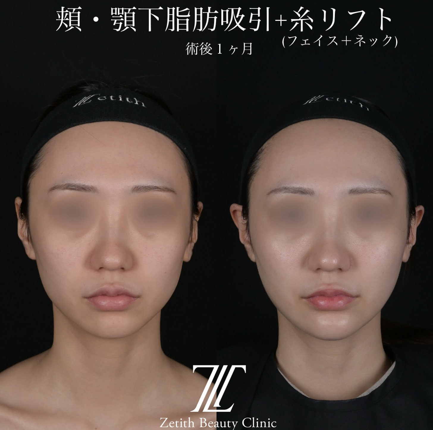 北村医師による脂肪吸引リフトの施術前／施術後1ヶ月