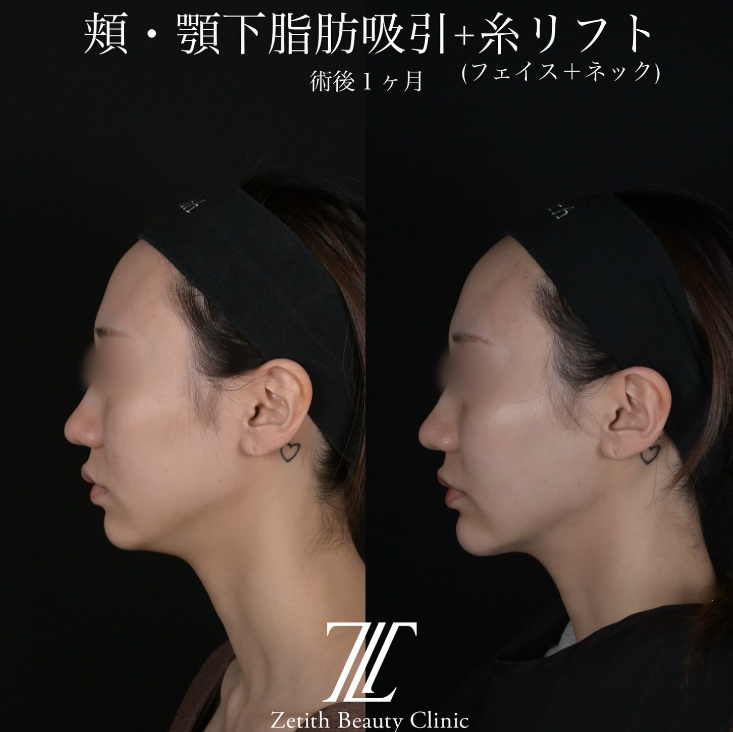 北村医師による脂肪吸引リフトの施術前／施術後1ヶ月 After 