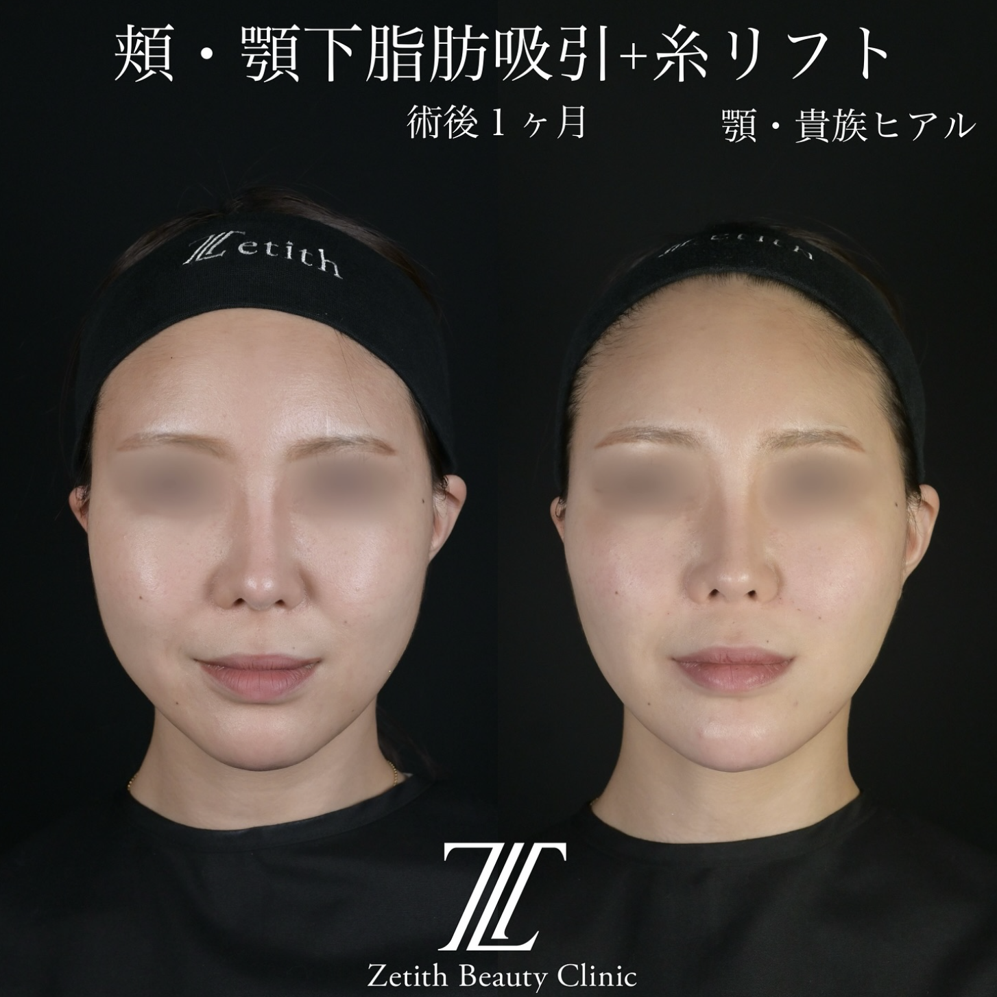 北村医師による脂肪吸引リフトの施術前／施術後1ヶ月