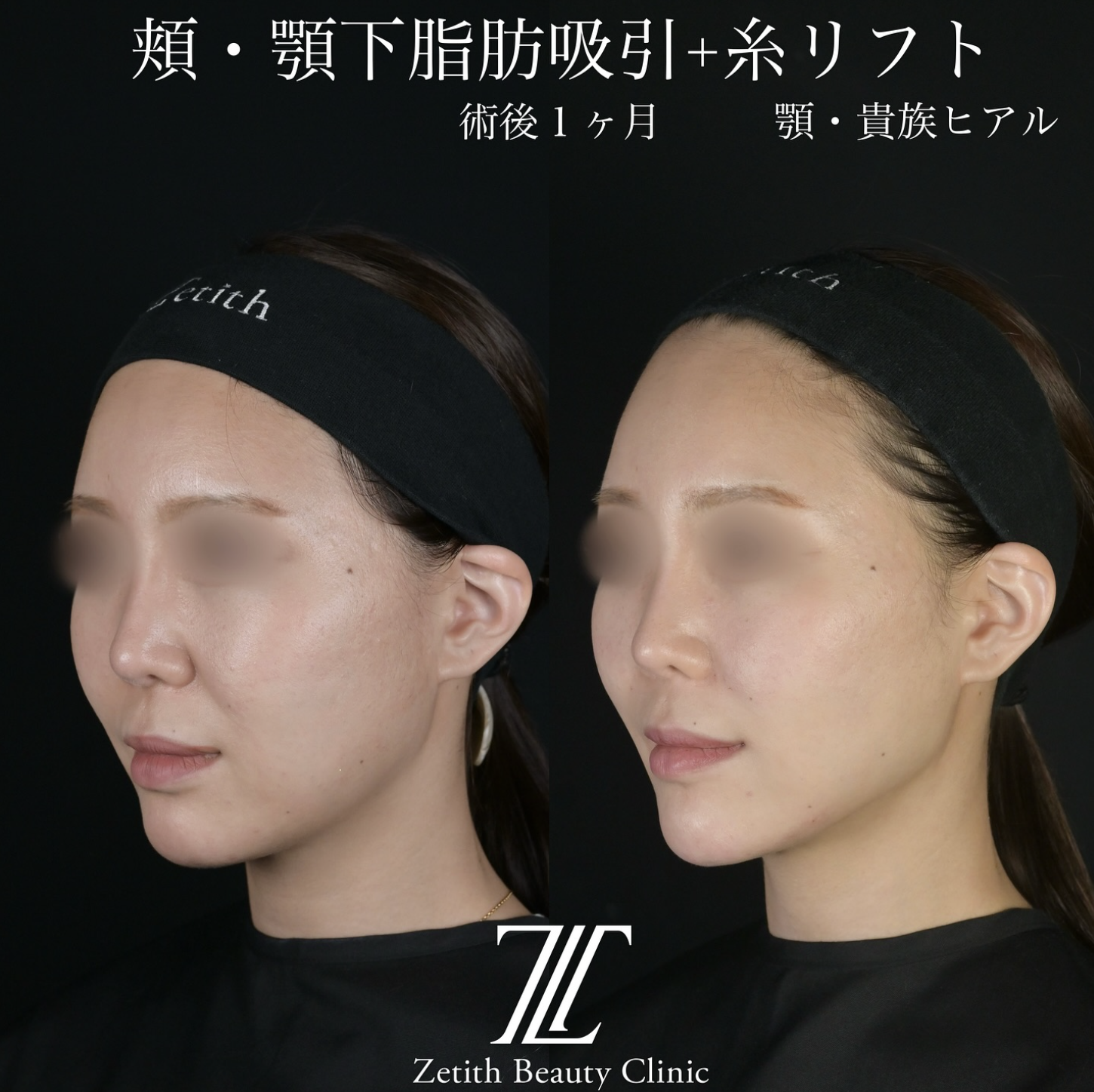 北村医師による脂肪吸引リフトの施術前／施術後1ヶ月 After 