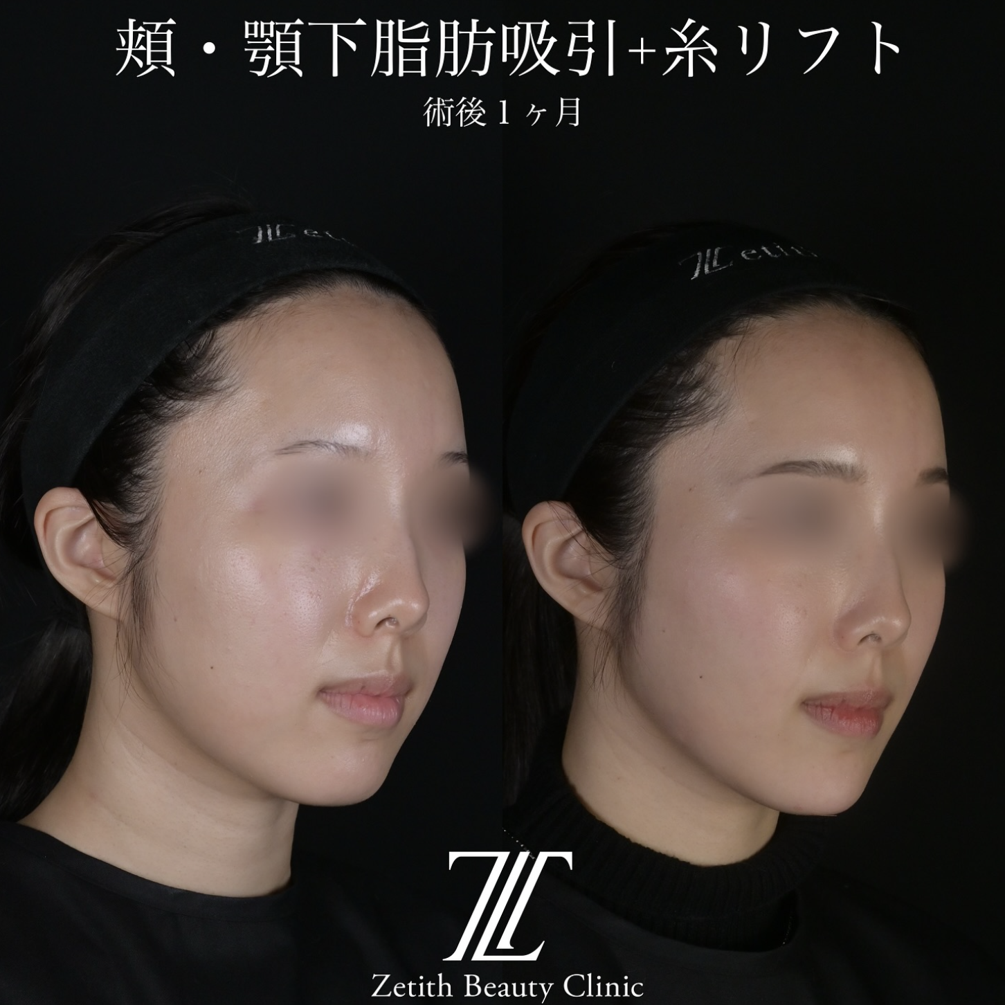 北村医師による脂肪吸引リフトの施術前／施術後1ヶ月