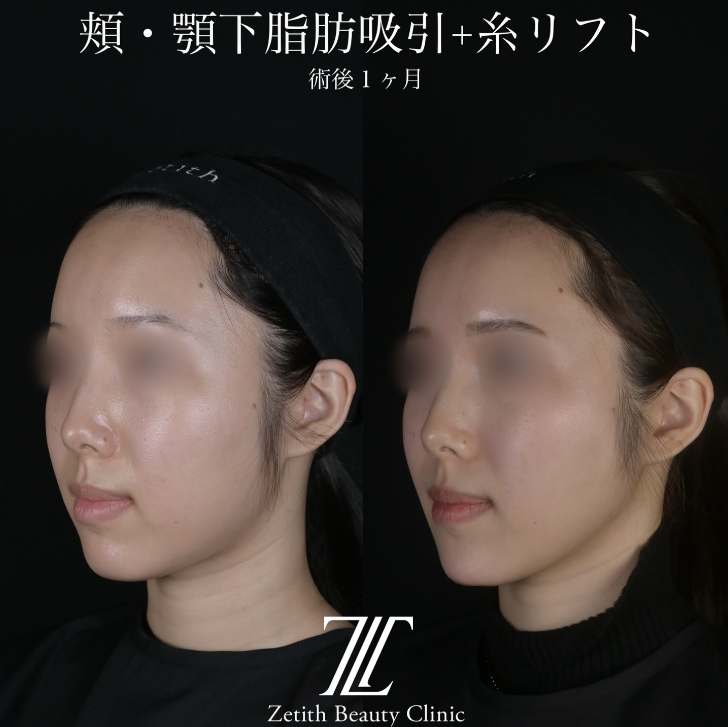 北村医師による脂肪吸引リフトの施術前／施術後1ヶ月 施術後 