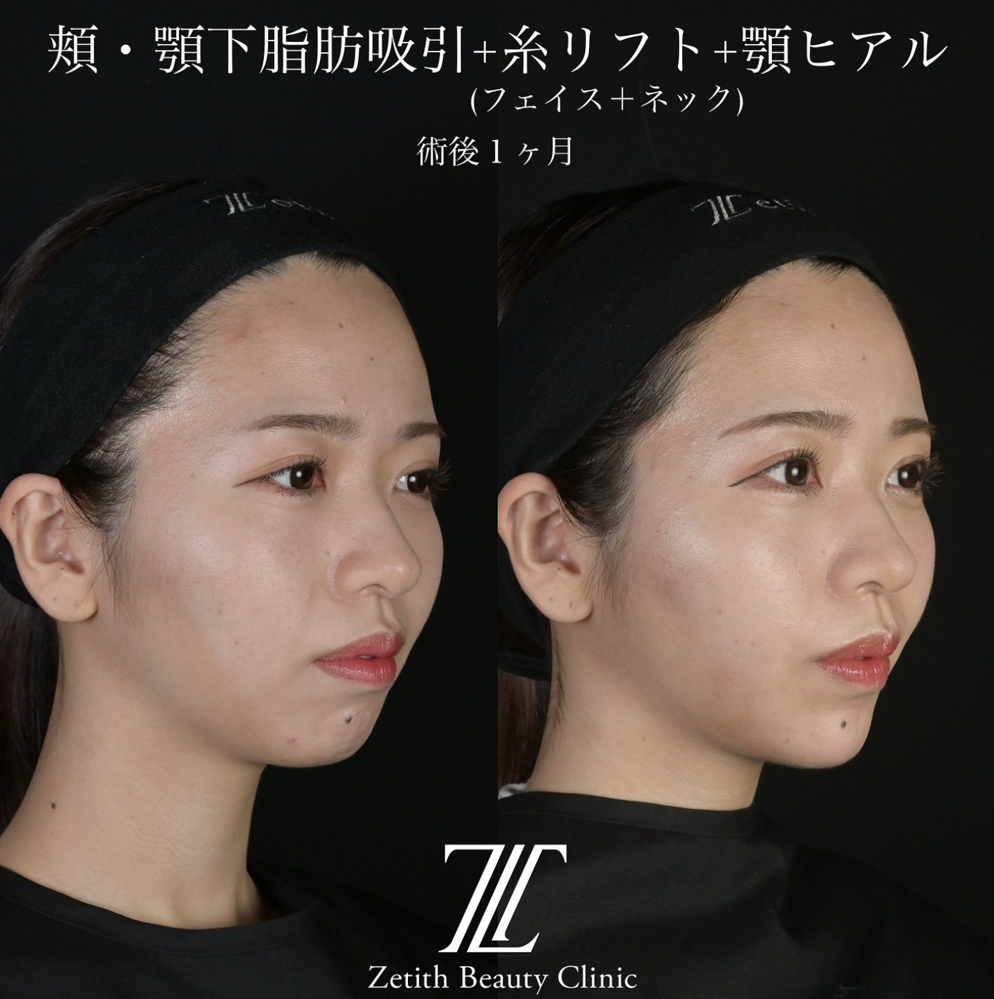 北村医師による脂肪吸引リフトの施術前／施術後1ヶ月