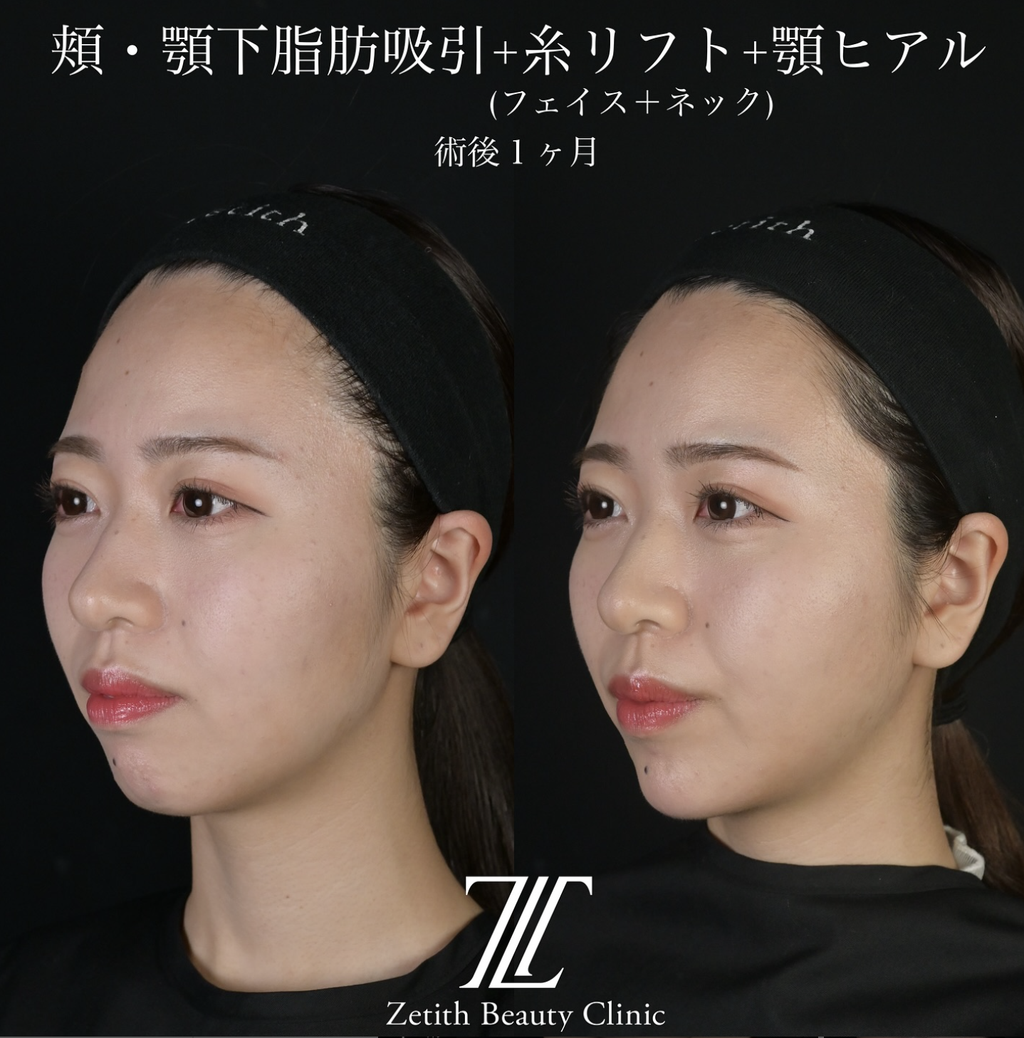 北村医師による脂肪吸引リフトの施術前／施術後1ヶ月 Дараа 