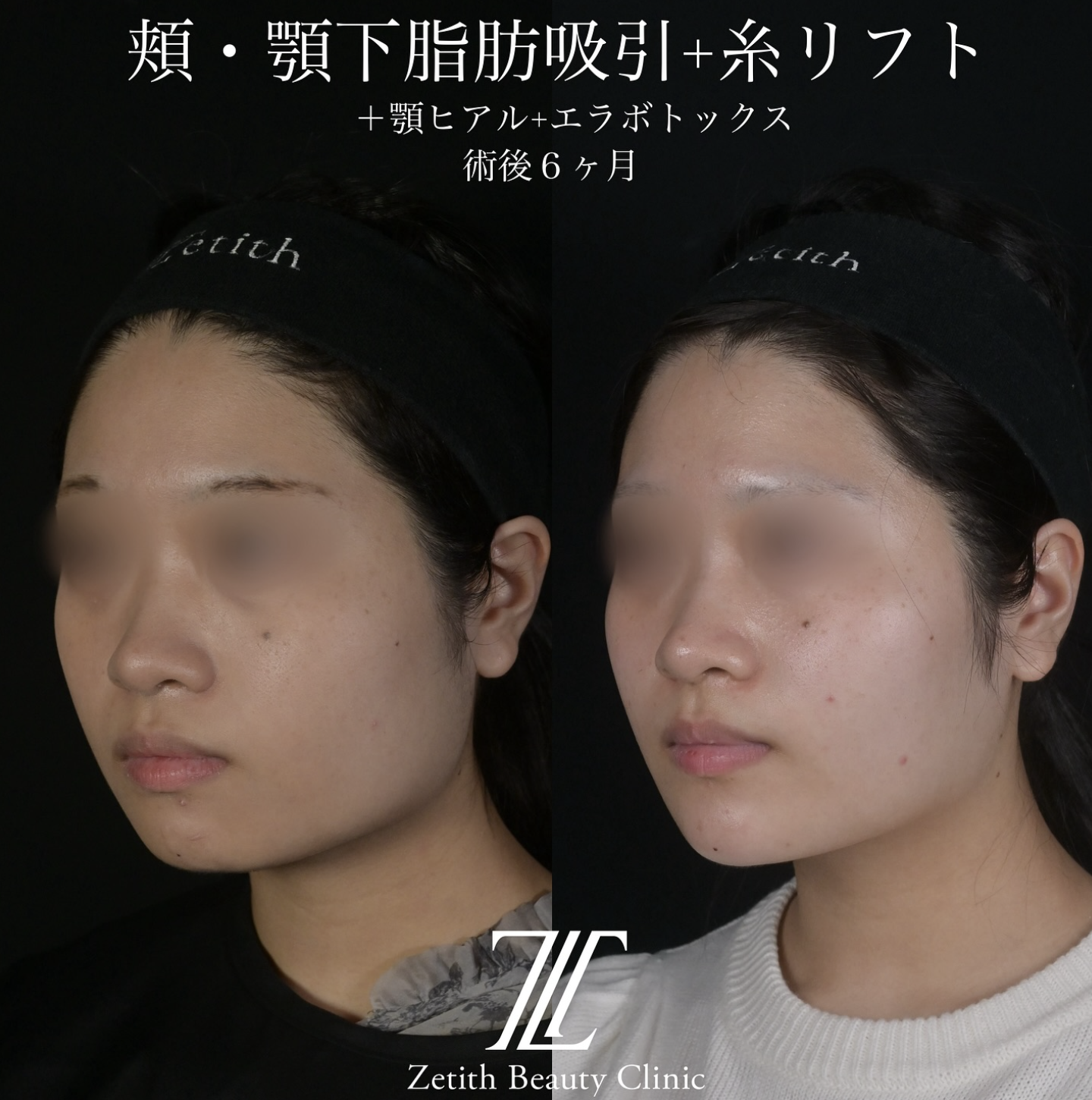 症例写真