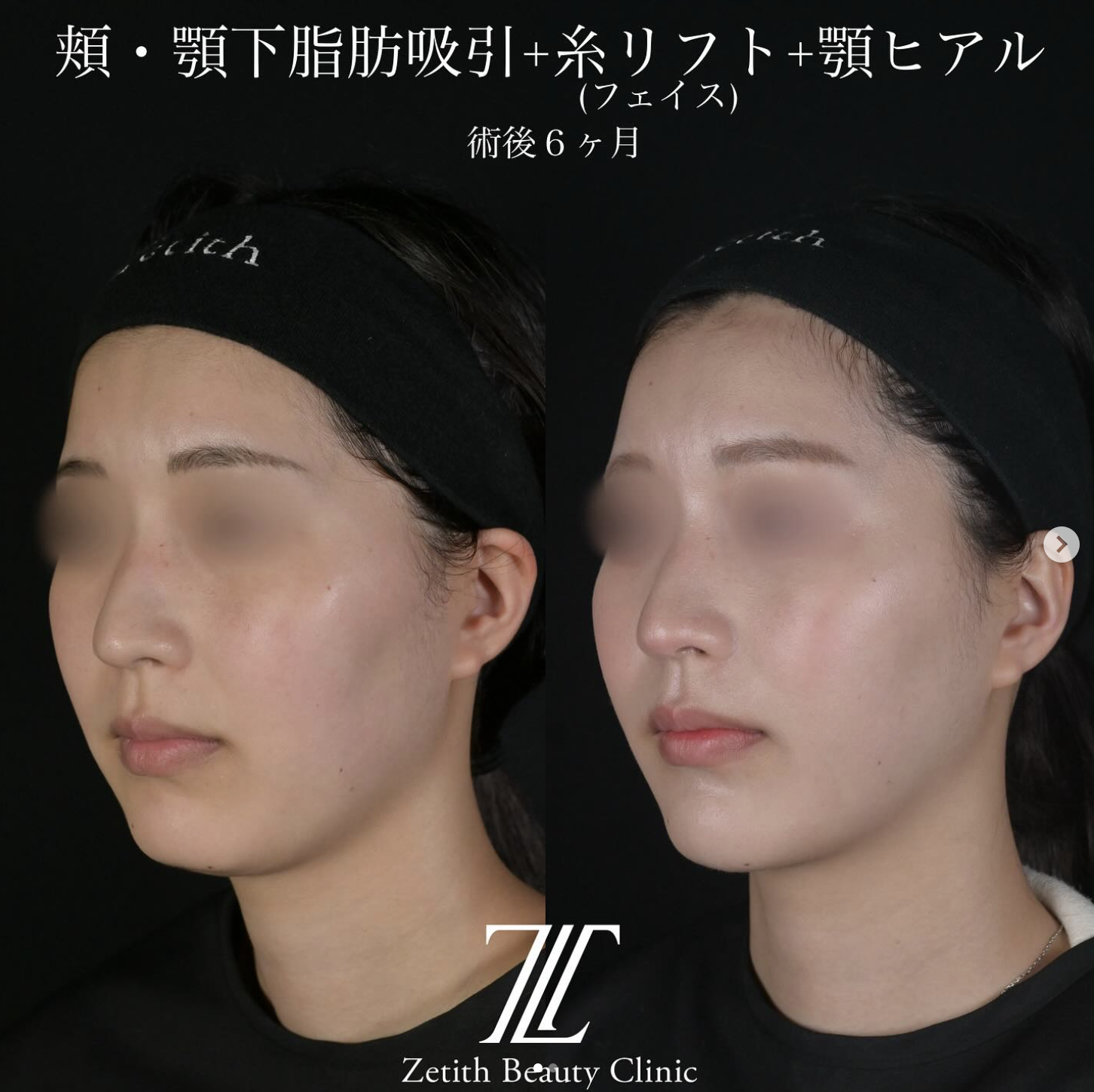 北村医師による脂肪吸引リフトの施術前／施術後6ヶ月
