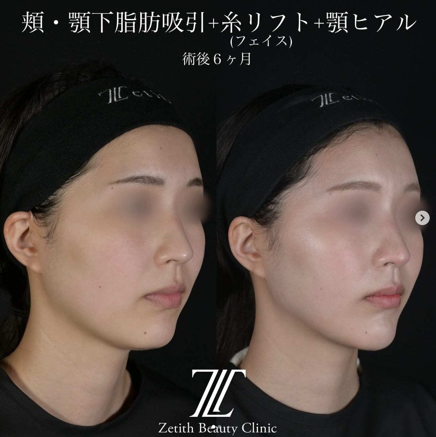 北村医師による脂肪吸引リフトの施術前／施術後6ヶ月 หลัง 