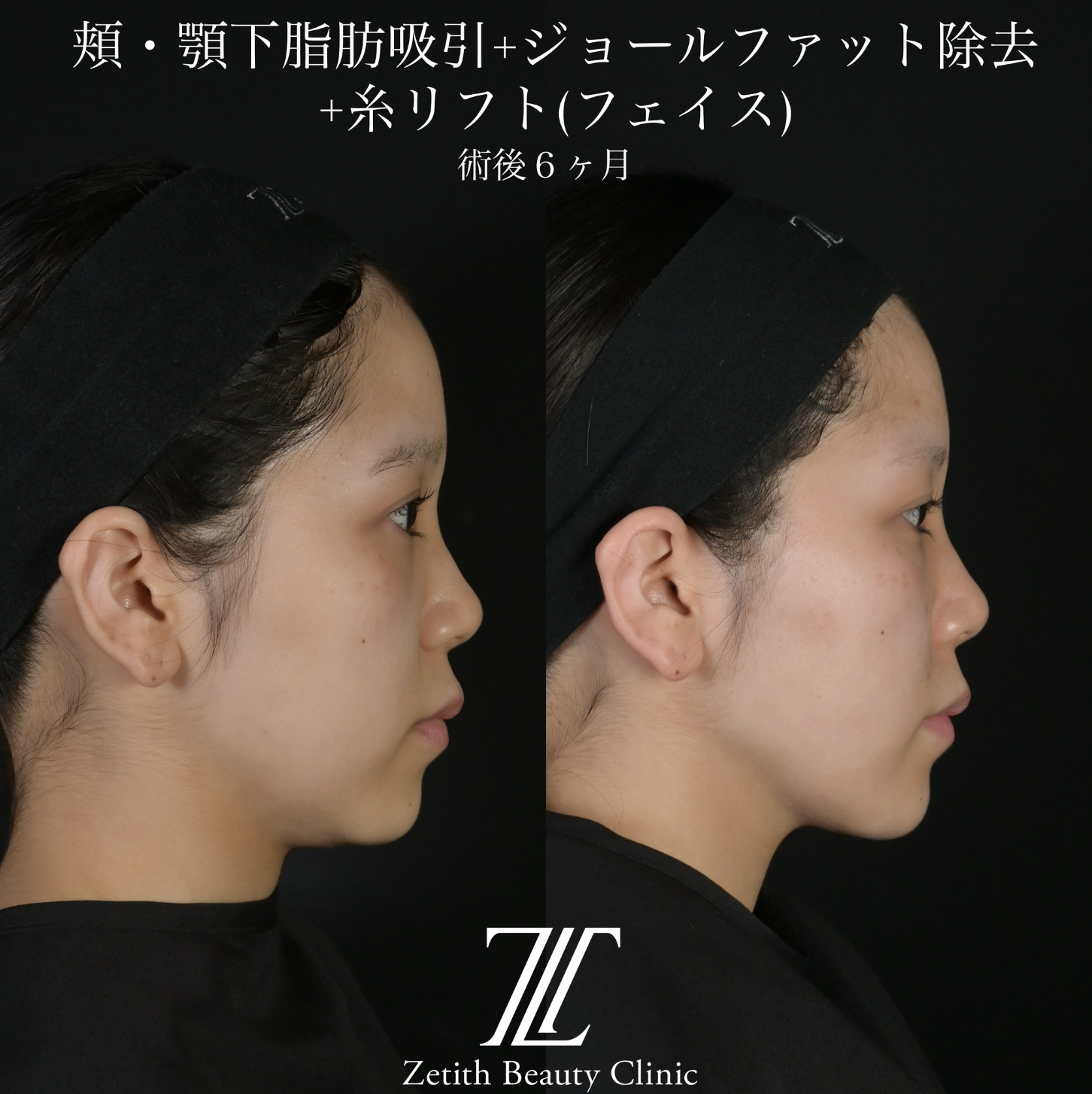 北村医師による複合施術の施術前／施術後6ヶ月