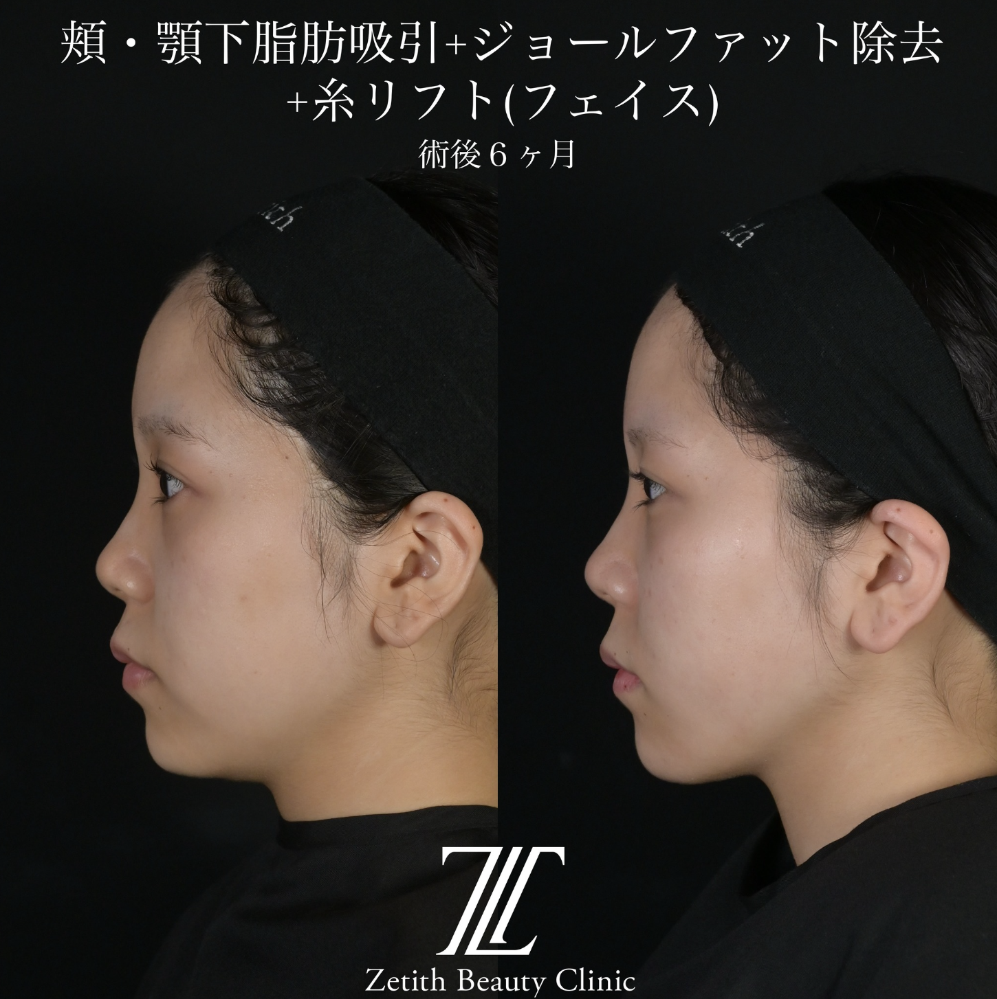 北村医師による複合施術の施術前／施術後6ヶ月 施術後 