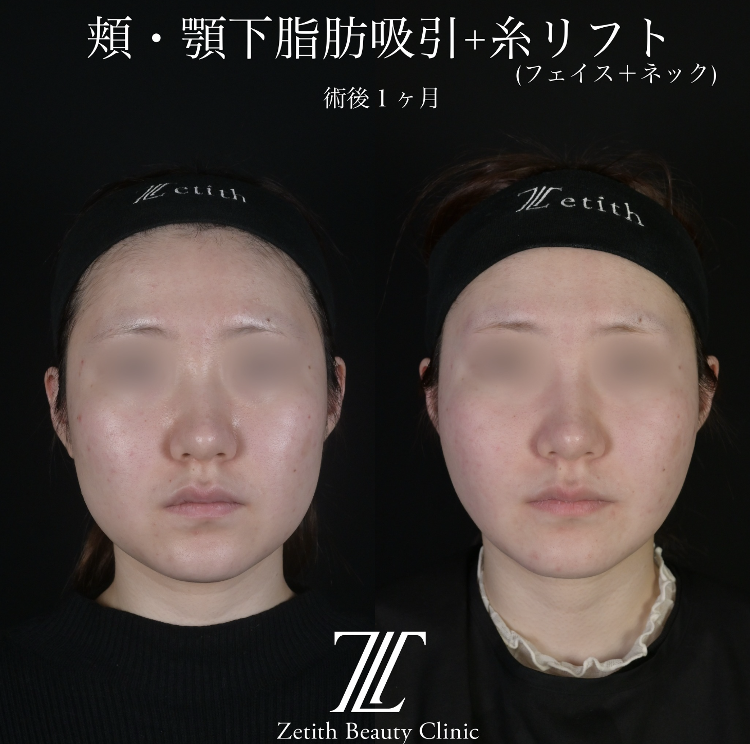 北村医師による脂肪吸引リフトの施術前／施術後1ヶ月