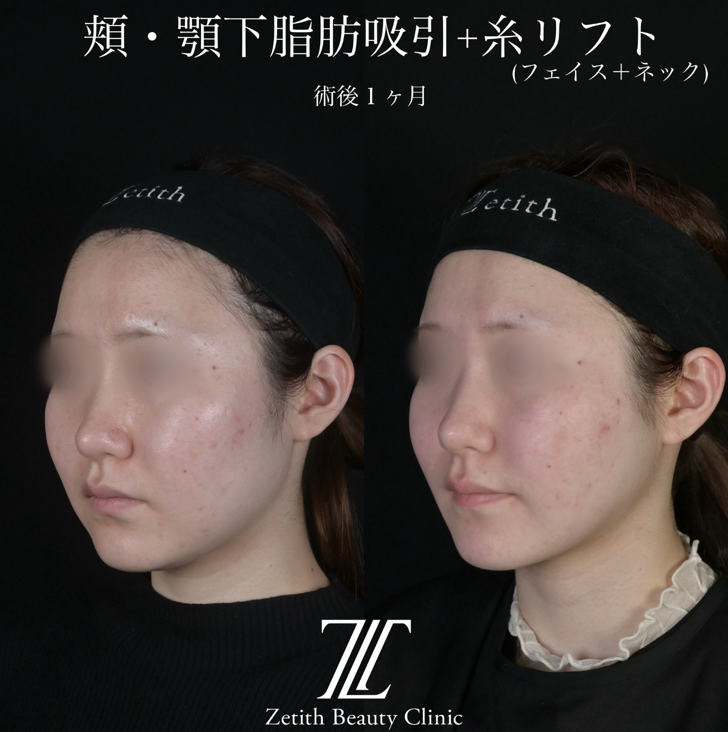 北村医師による脂肪吸引リフトの施術前／施術後1ヶ月 Sau 