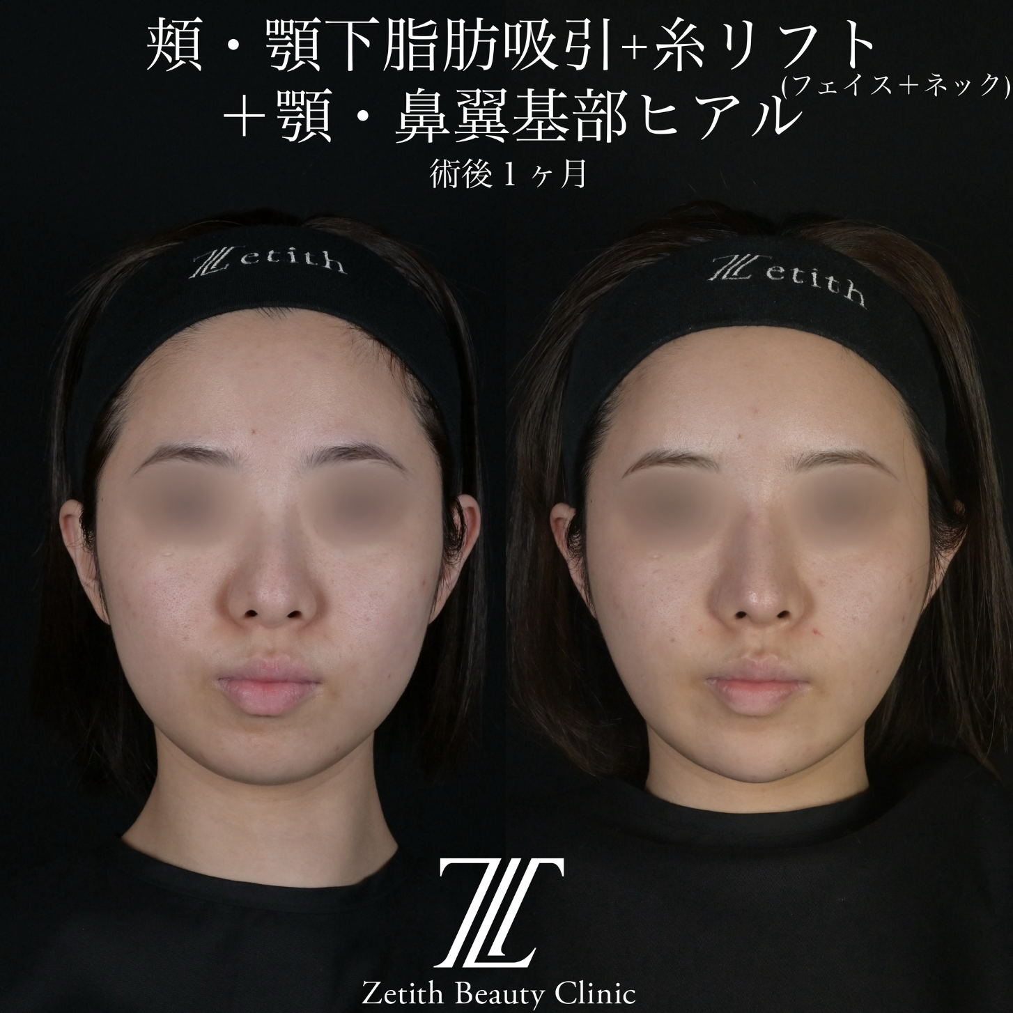 北村医師による脂肪吸引リフトの施術前／施術後1ヶ月