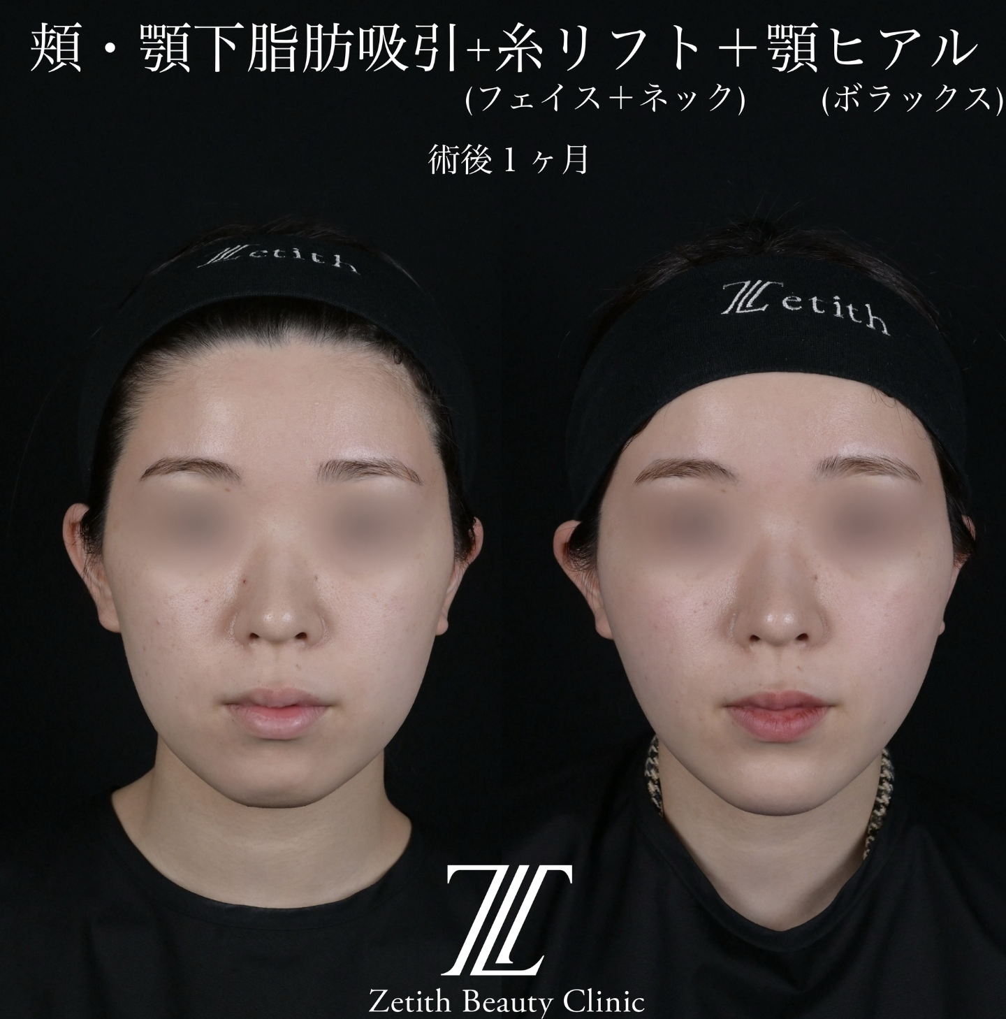 北村医師による脂肪吸引リフトの施術前／施術後1ヶ月