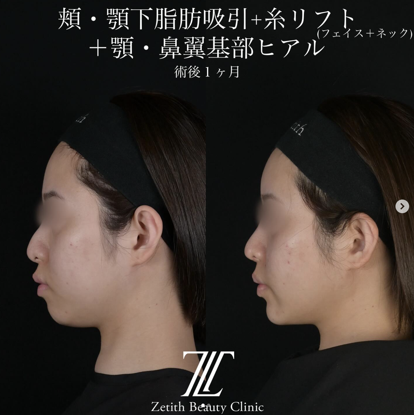 北村医師による脂肪吸引リフトの施術前／施術後1ヶ月 After 