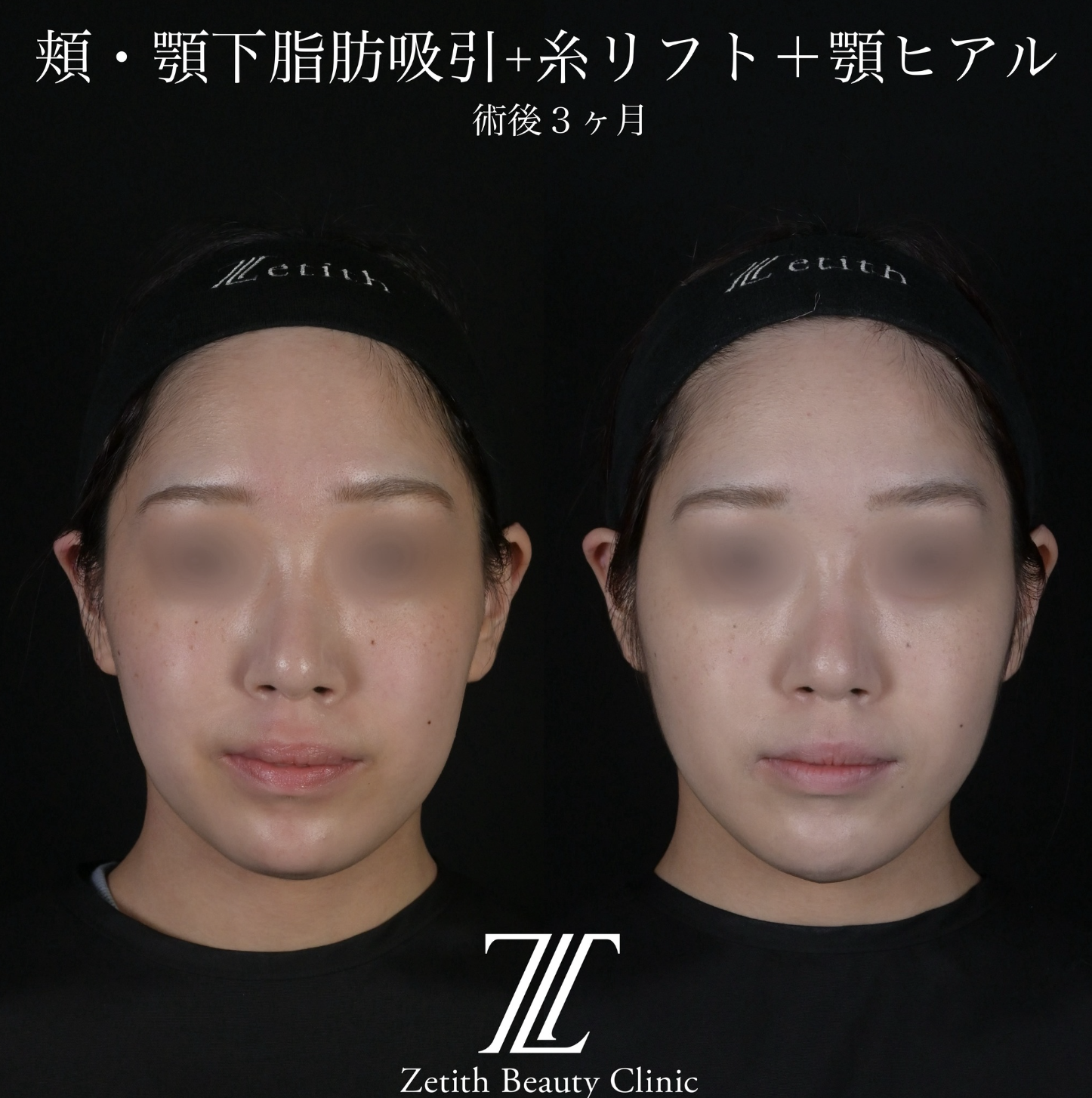 北村医師による脂肪吸引リフトの施術前／施術後3ヶ月
