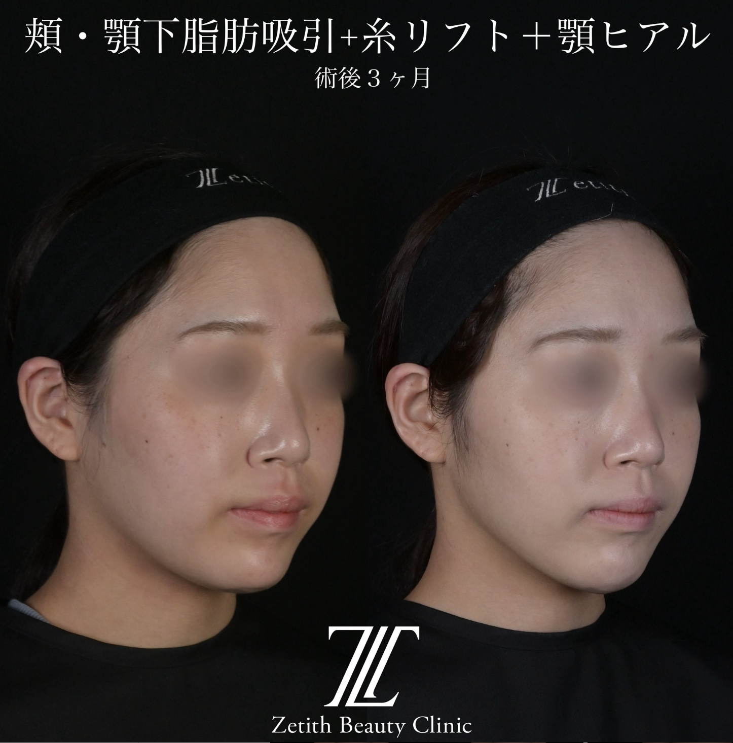 北村医師による脂肪吸引リフトの施術前／施術後3ヶ月 施術後 