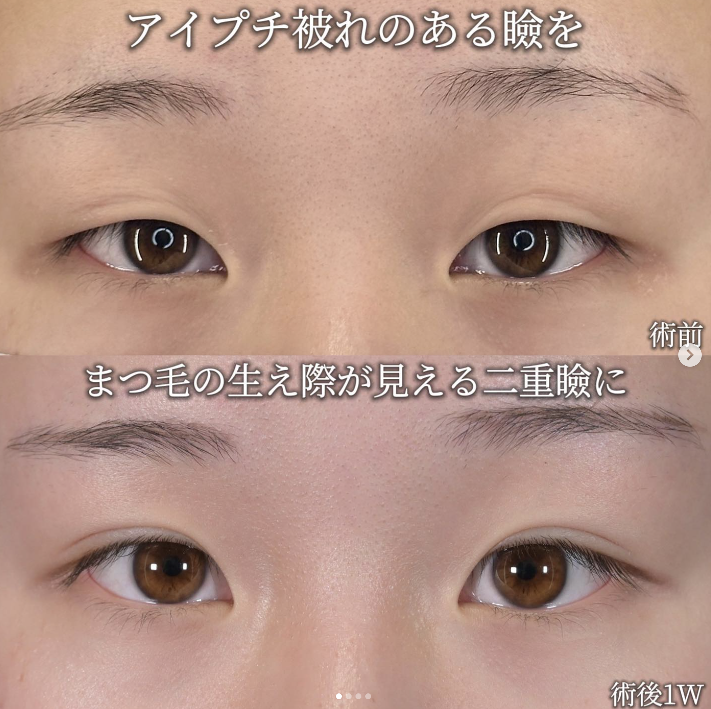 沈医師による二重埋没法の施術前／施術後1週間