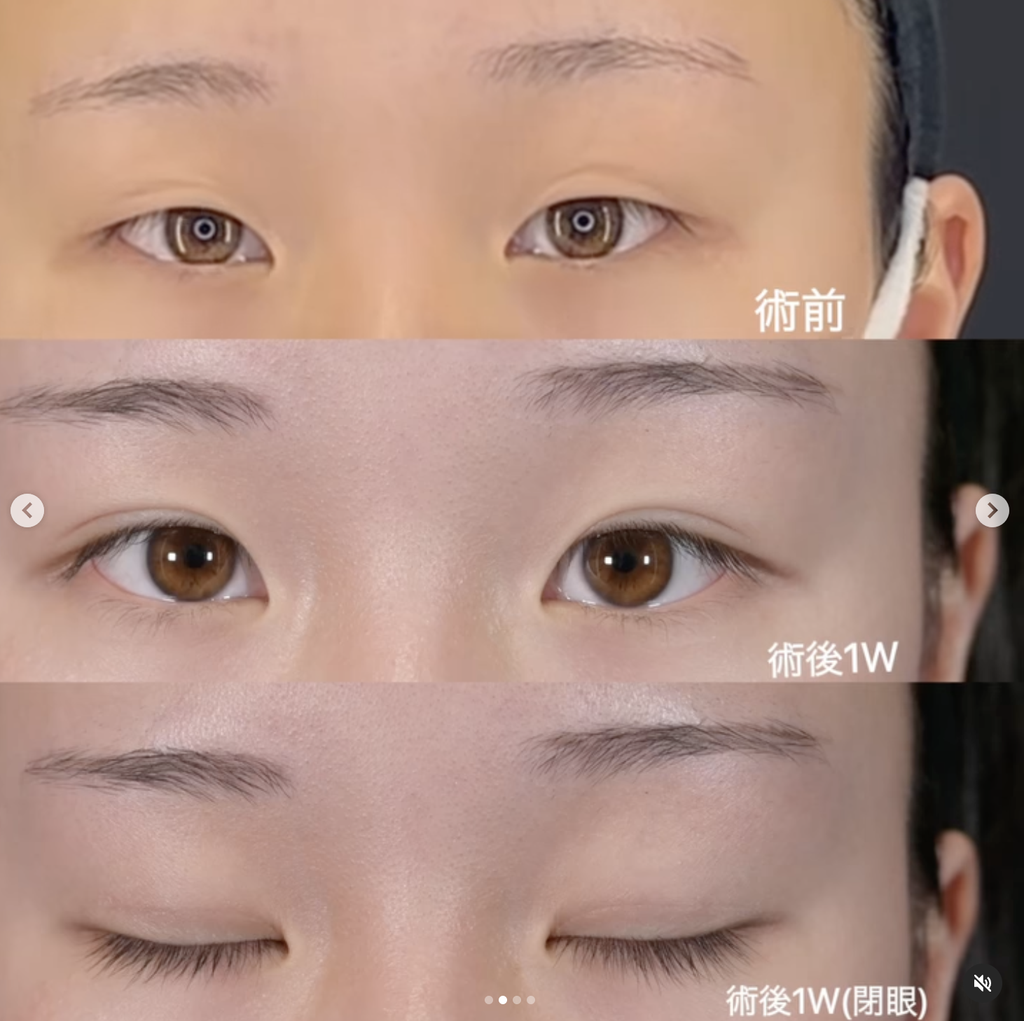沈医師による二重埋没法の施術前／施術後1週間 หลัง 