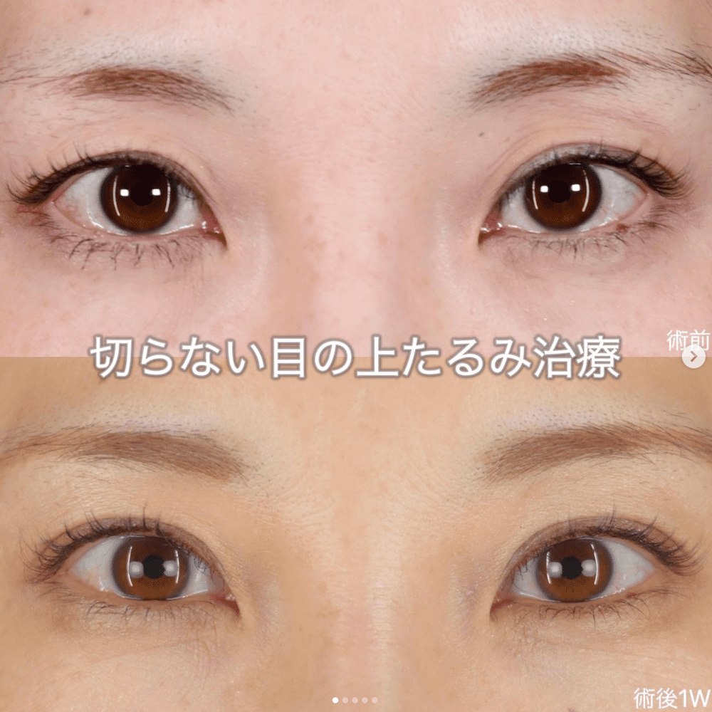 沈医師による自然癒着法の施術前／施術後1週間