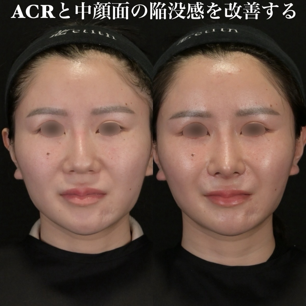 鉄医師による鼻整形の術前/術後1ヶ月