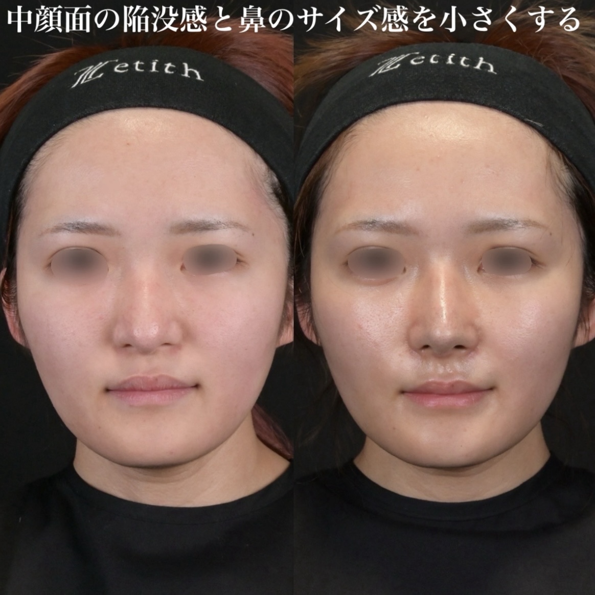 鉄医師による鼻整形の術前/術後2週間