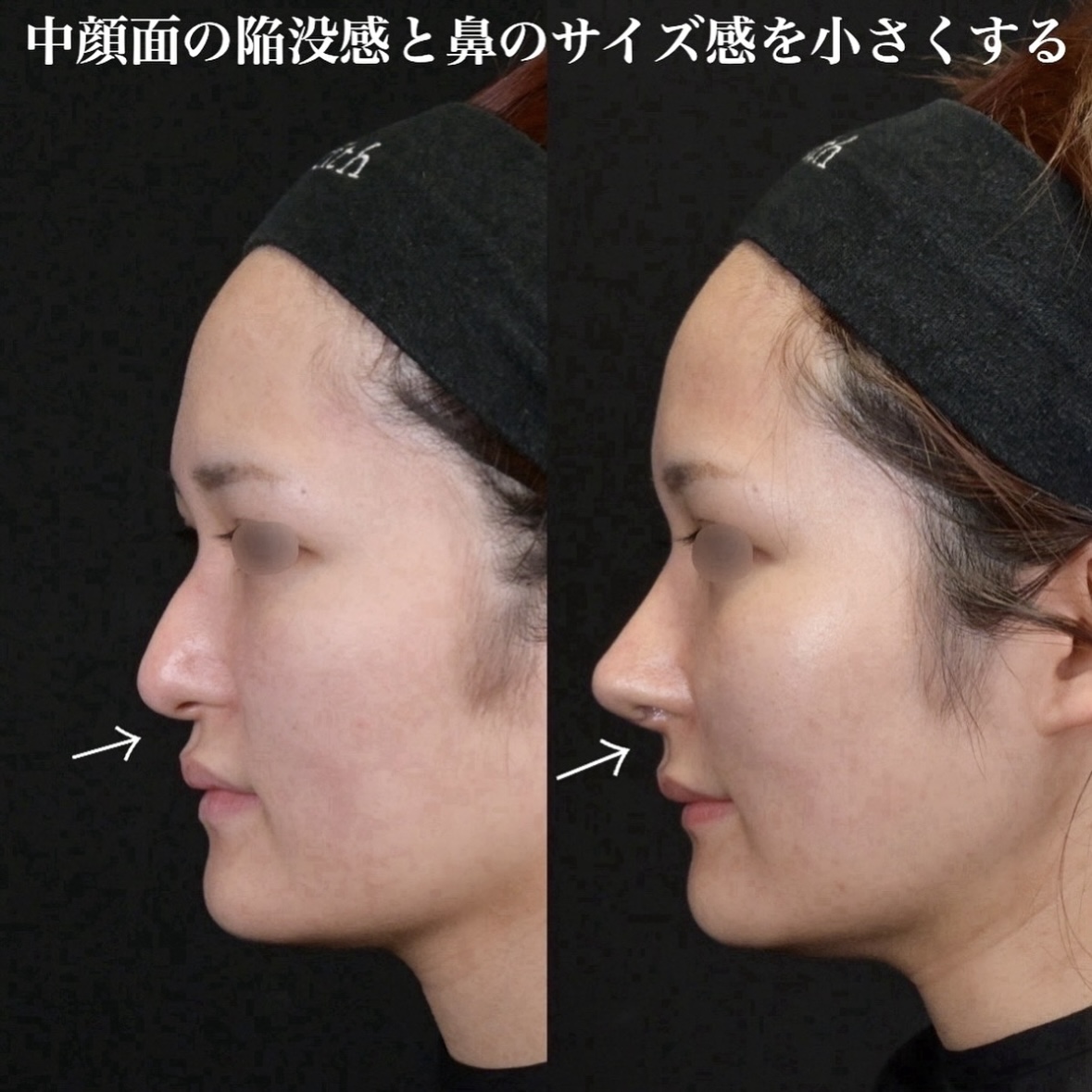 鉄医師による鼻整形の術前/術後2週間 施術後 