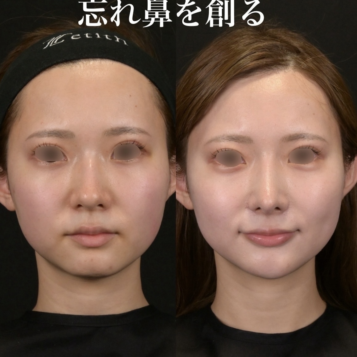 鉄医師による鼻整形の術前/術後3ヶ月