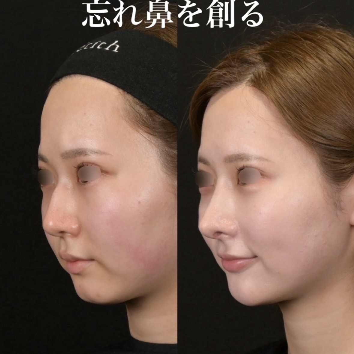 鉄医師による鼻整形の術前/術後3ヶ月 施術後 