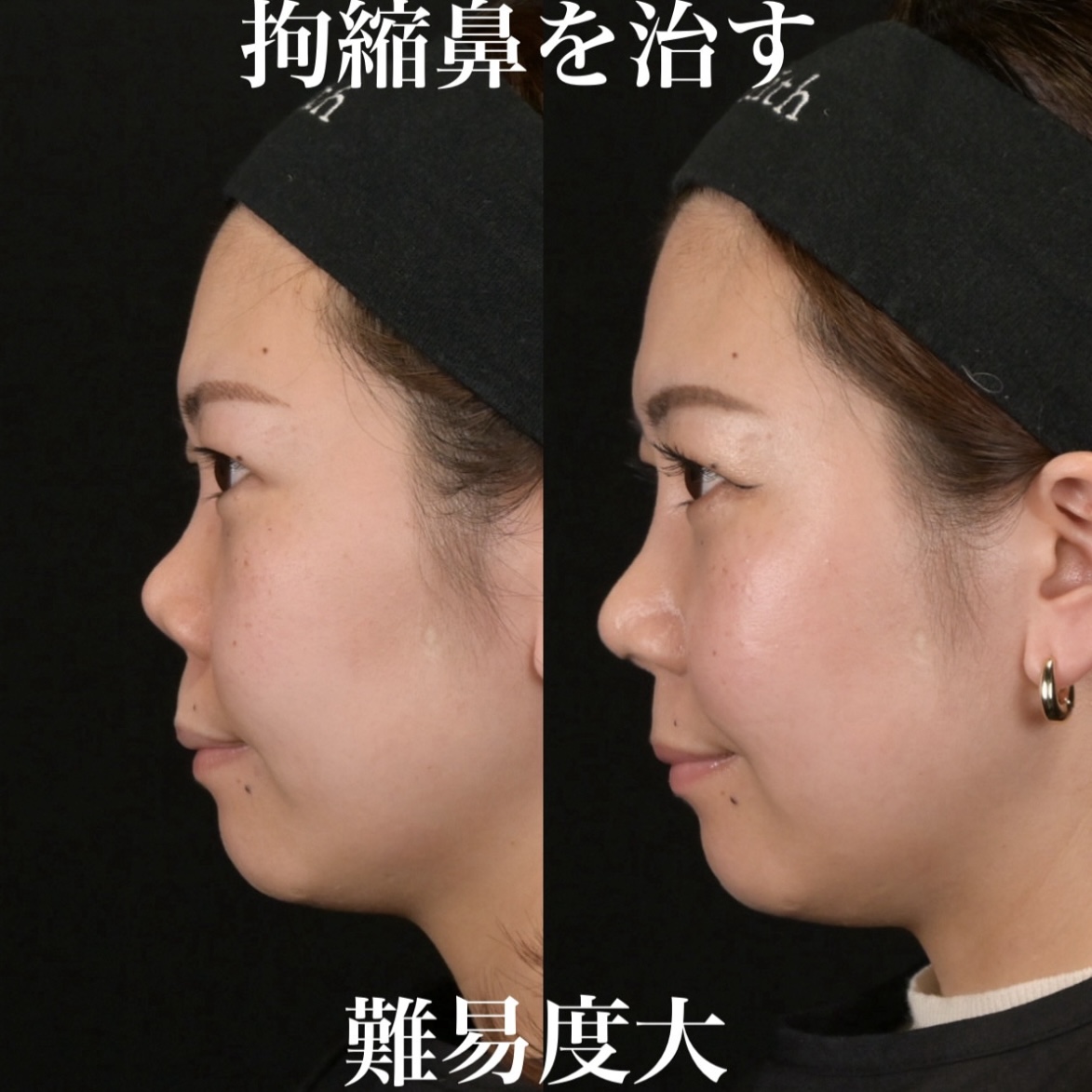 鉄医師による鼻整形の術前/術後3ヶ月 施術後 