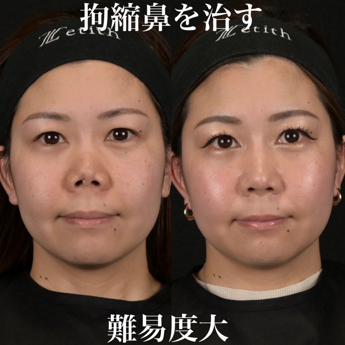 鉄医師による鼻整形の術前/術後3ヶ月