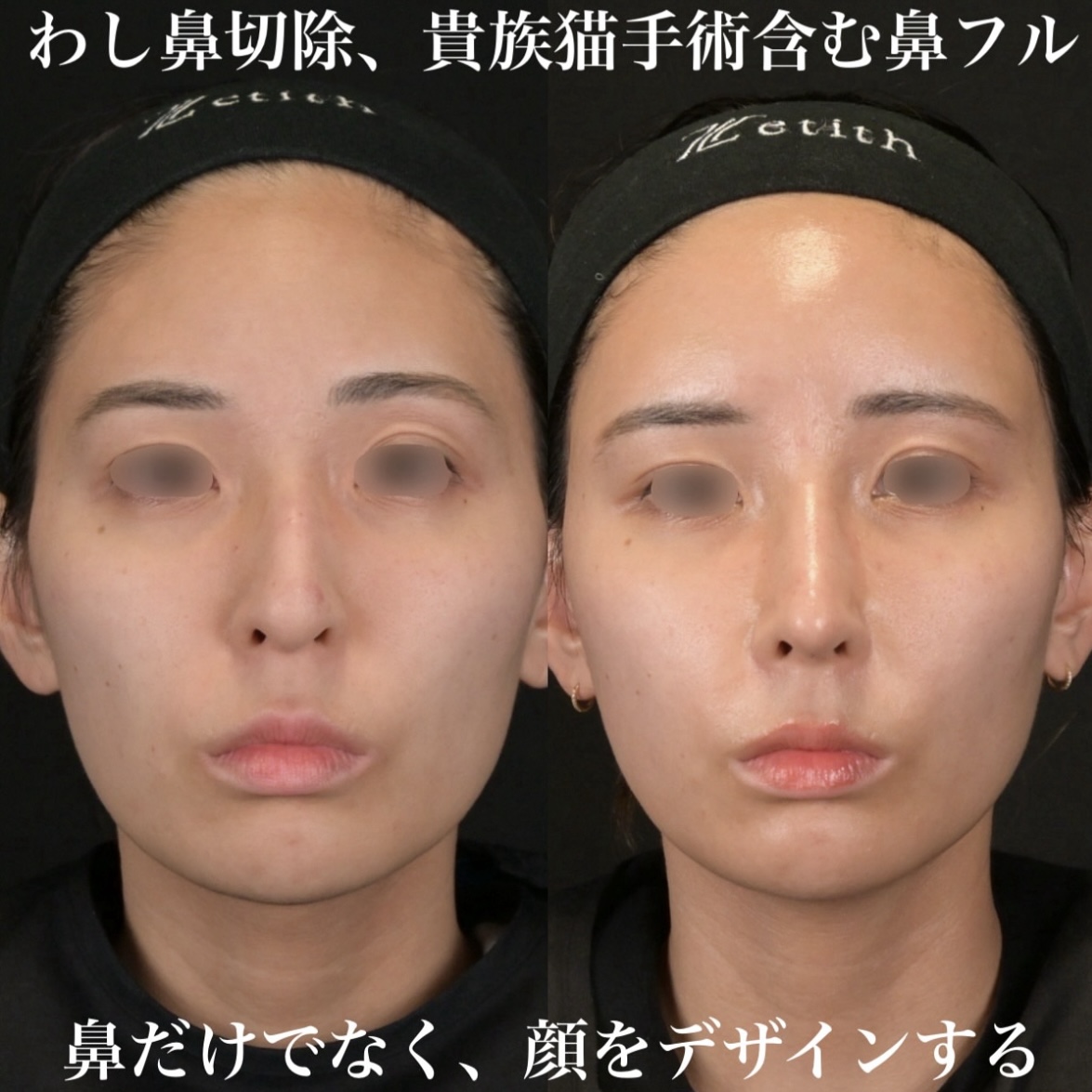 鉄医師による鼻整形の術前/術後2週間