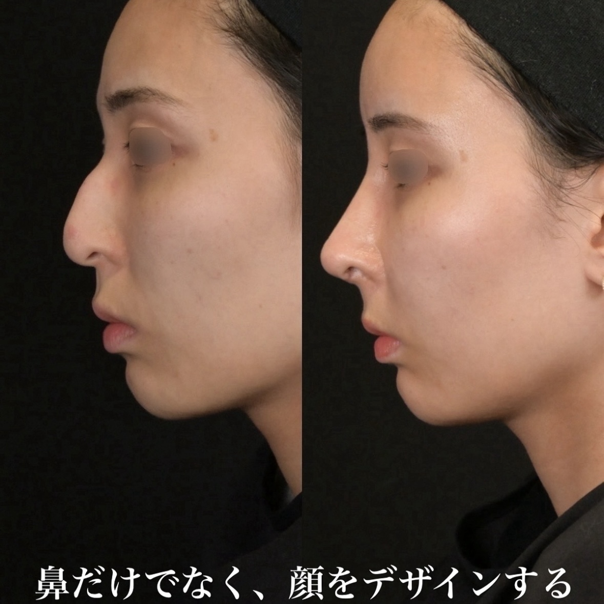 鉄医師による鼻整形の術前/術後2週間 术后 