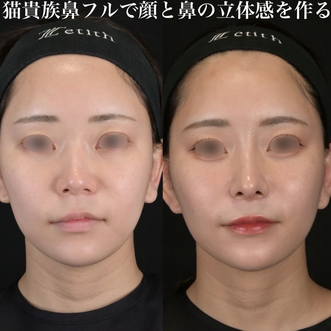 鉄医師による鼻整形の術前/術後1ヶ月
