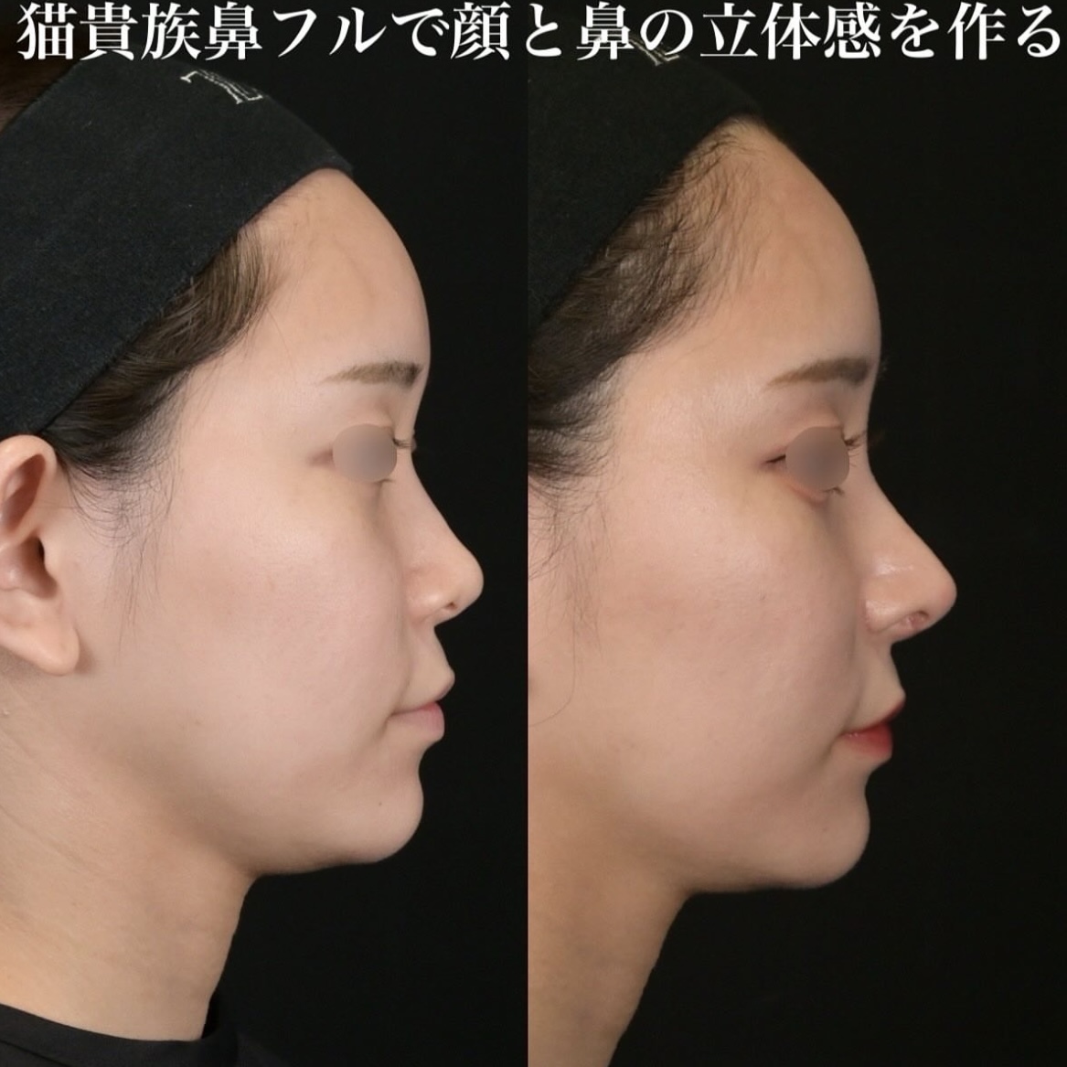 鉄医師による鼻整形の術前/術後1ヶ月 施術後 